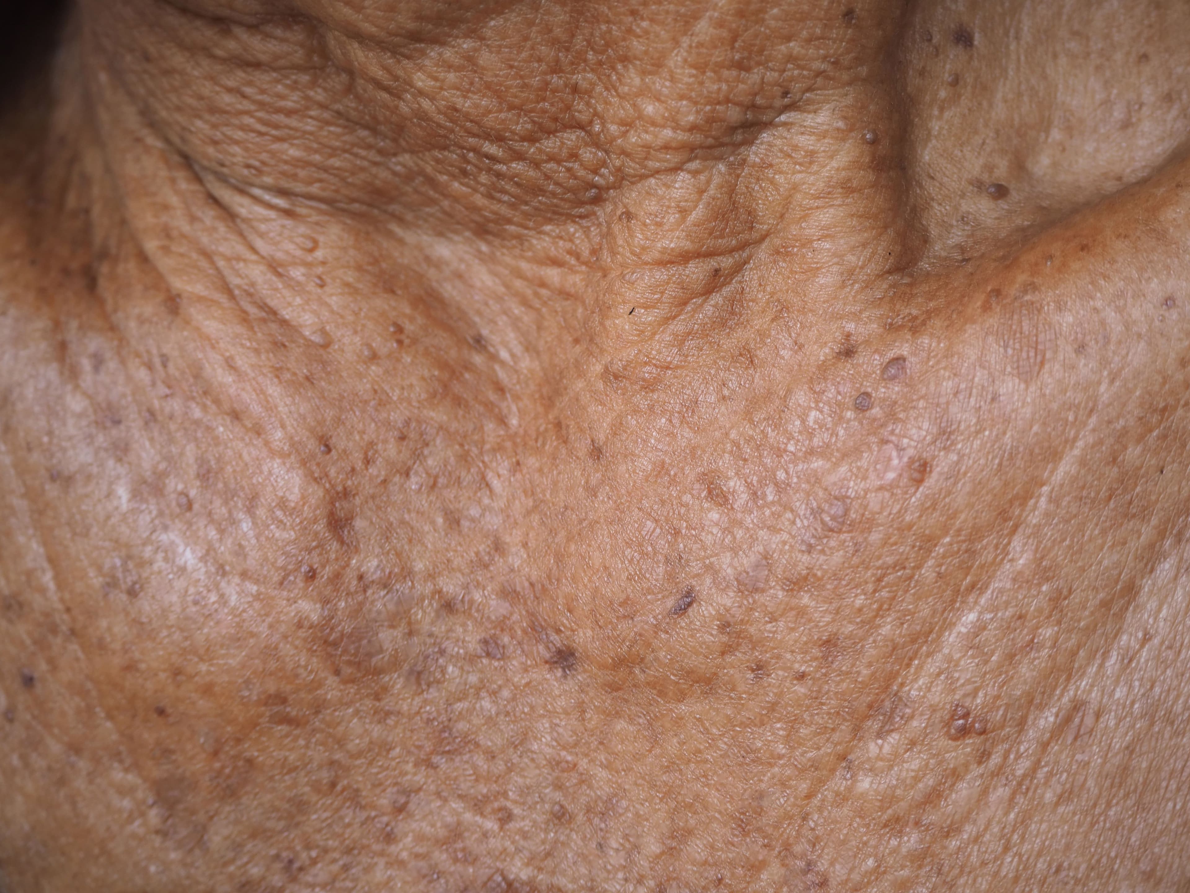 Tirbanibulin Demonstrates Efficacy for Actinic Keratosis in Larger Field Treatment