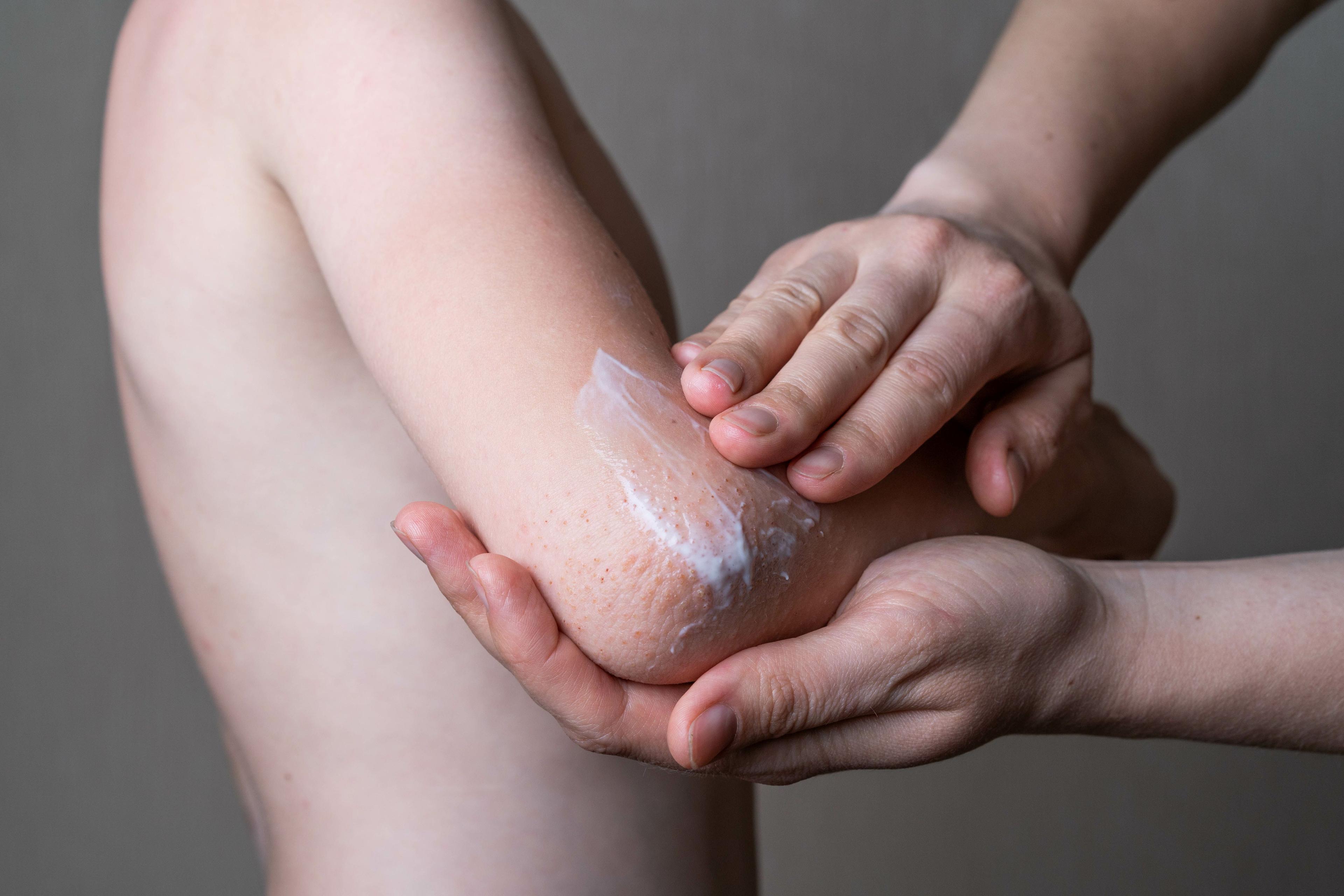 Adult applying topical cream on elbow of a young child