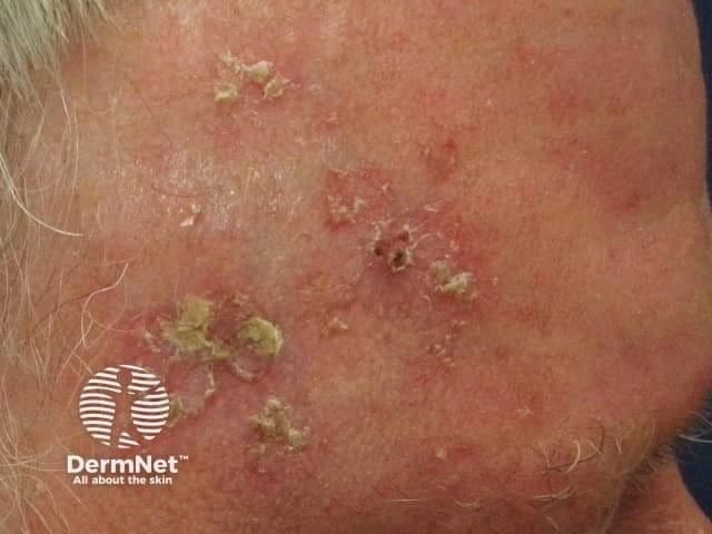 Patient with Actinic Keratosis | Image Credit: © DermNet