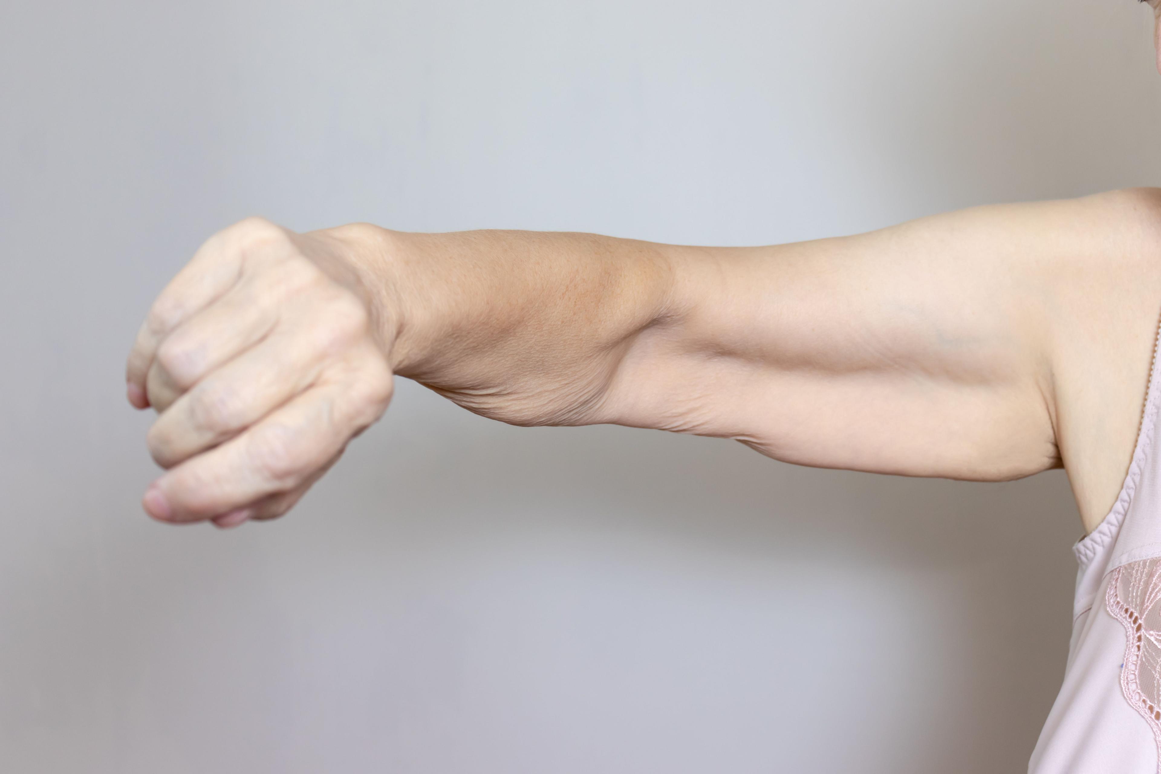 Single-Plane vs Double-Plane MFU-V for Upper Arm Skin Laxity