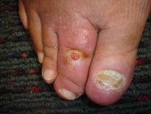 Diabetic foot ulcer