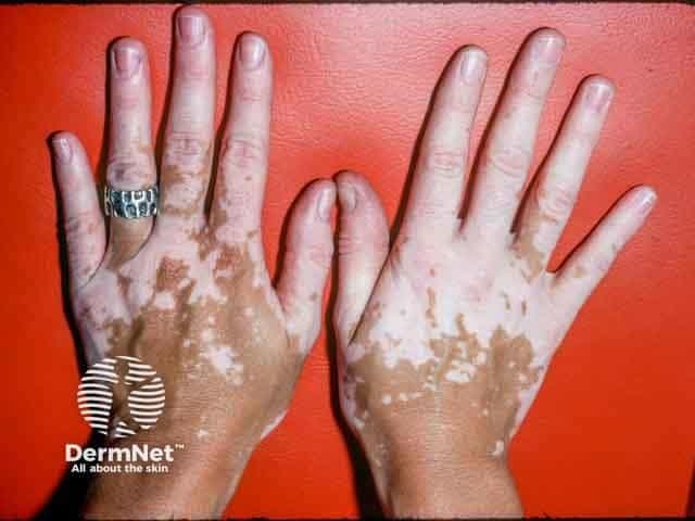 Patient with vitiligo on hands | Image Credit: © dermnetnz.org