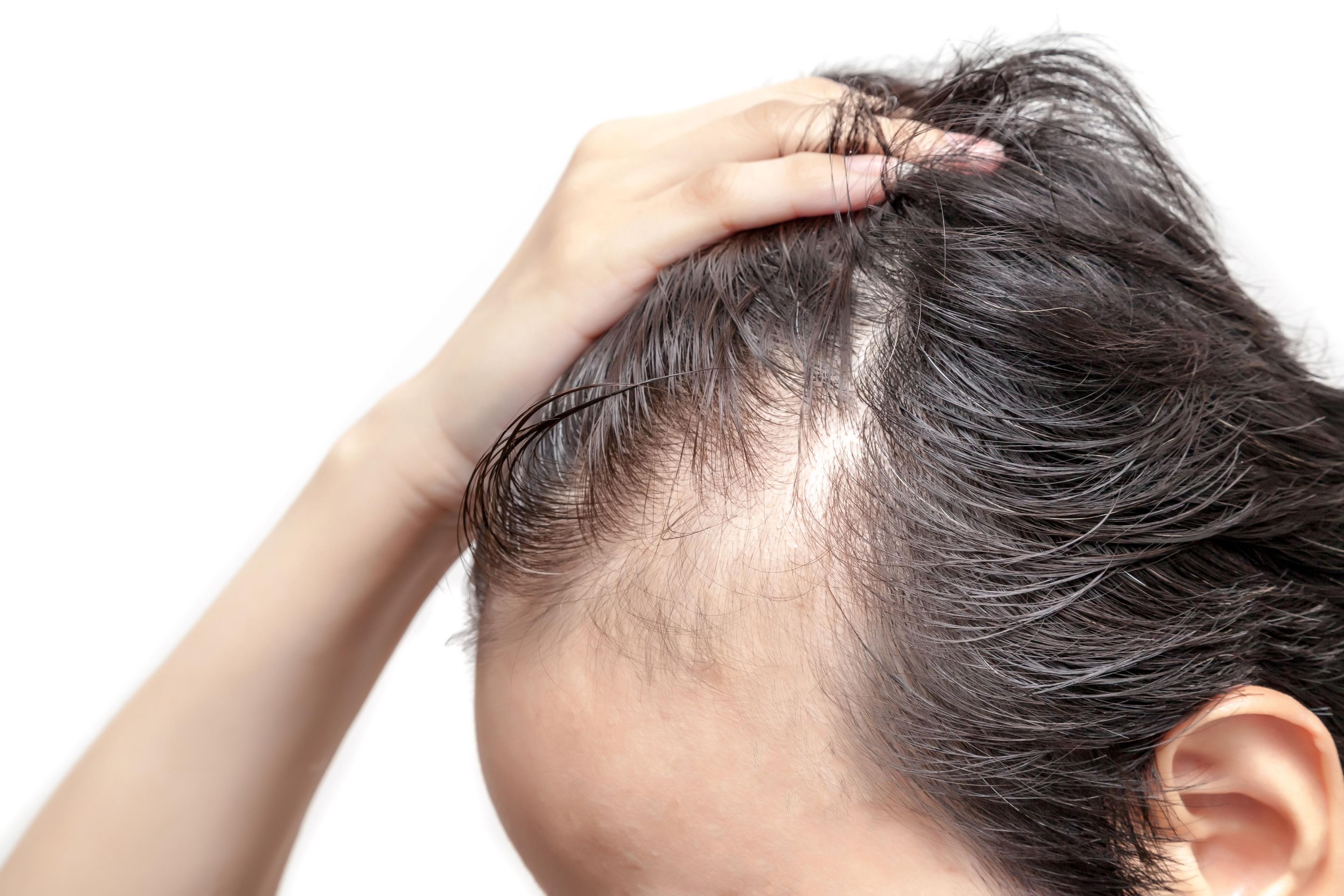 Patient with hair loss | Image Credit: © Bongkochrut - stock.adobe.com