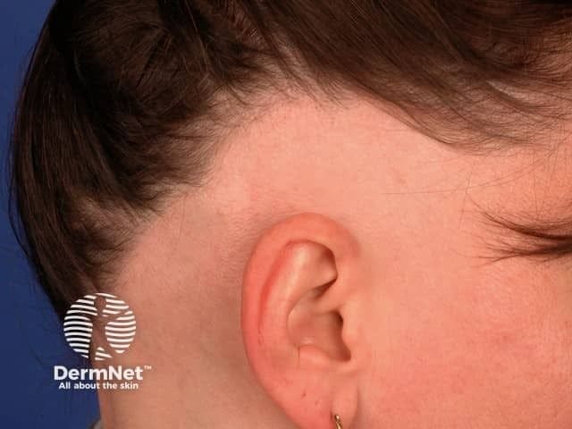 DPCP Immunotherapy Yields 61.8% Hair Regrowth Rate in Pediatric Alopecia Areata