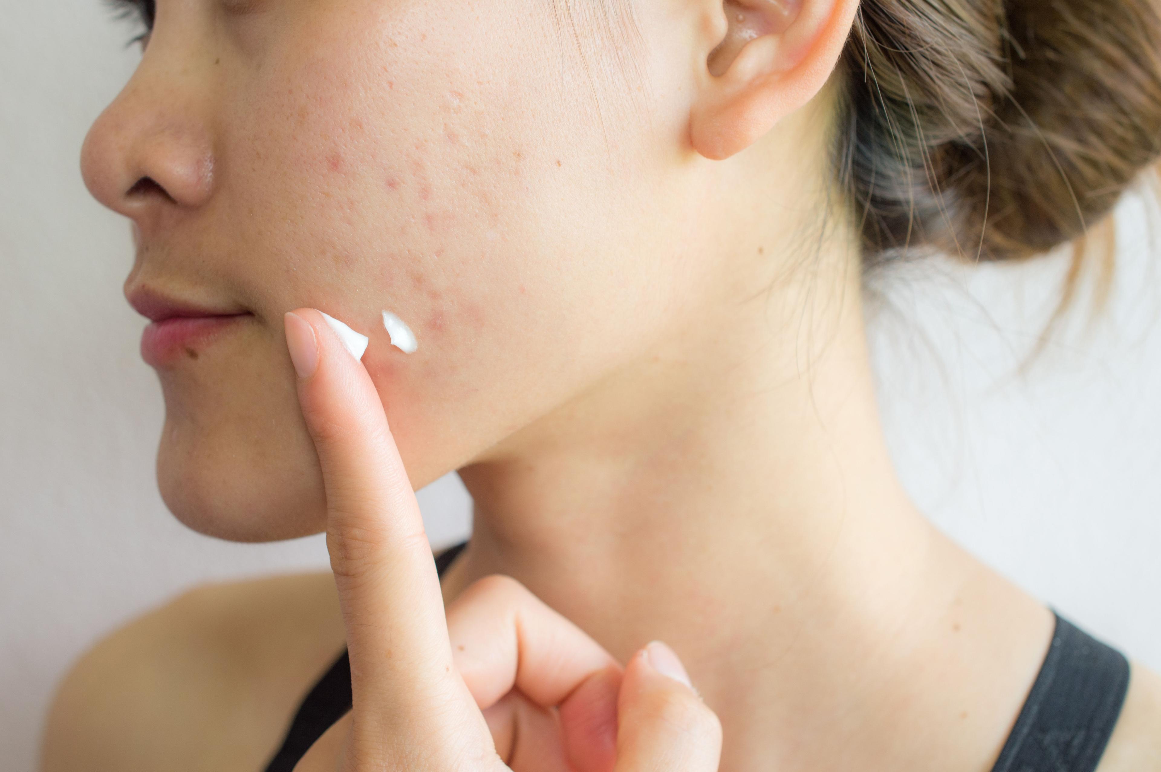 Patient using acne cream | Image credit: © boyloso - stock.adobe.com