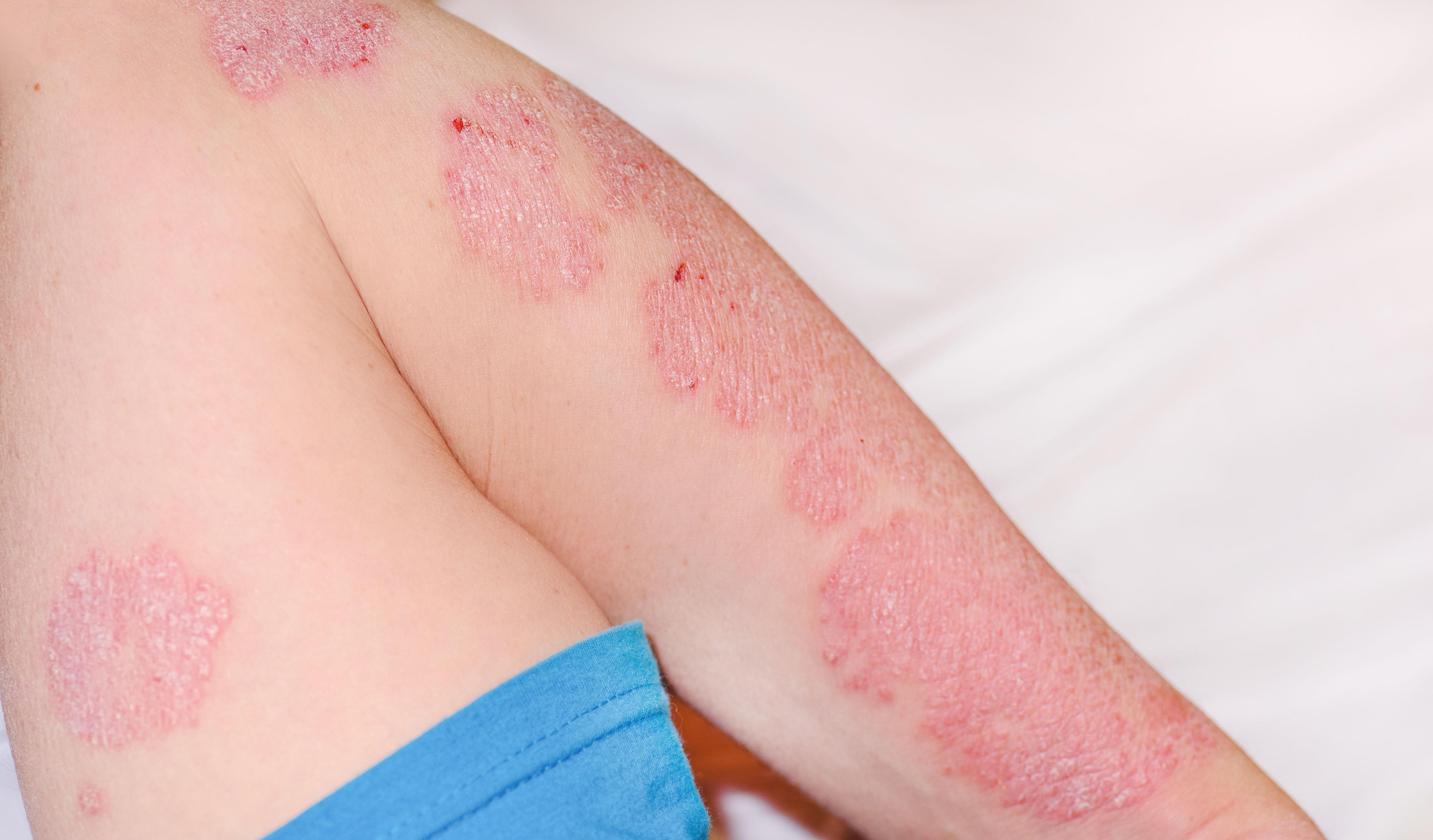 Psoriasis on the bent arm of a man