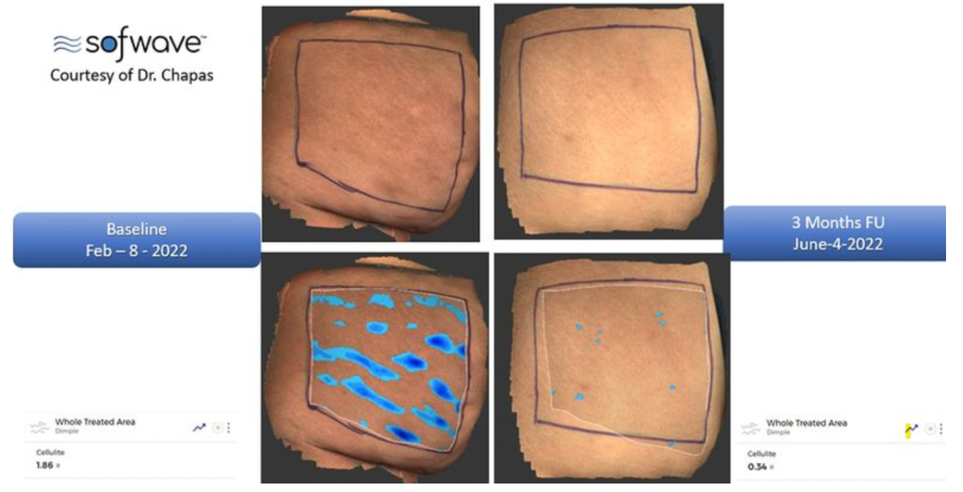 Sofwave treatment comparison photos