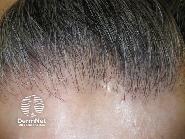 Frontal fibrosing alopecia | Image credit: © DermNet