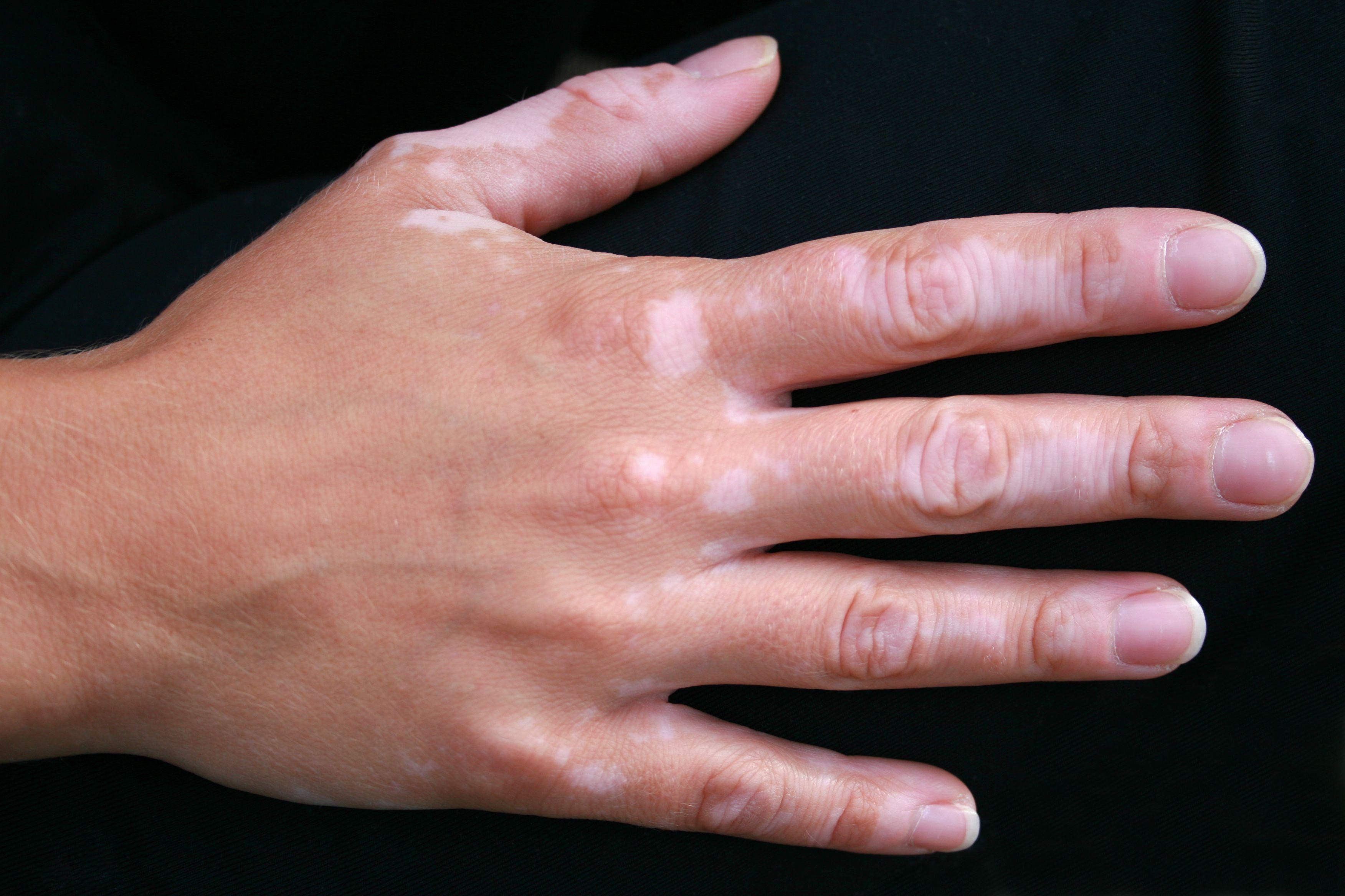 Vitiligo on the hand