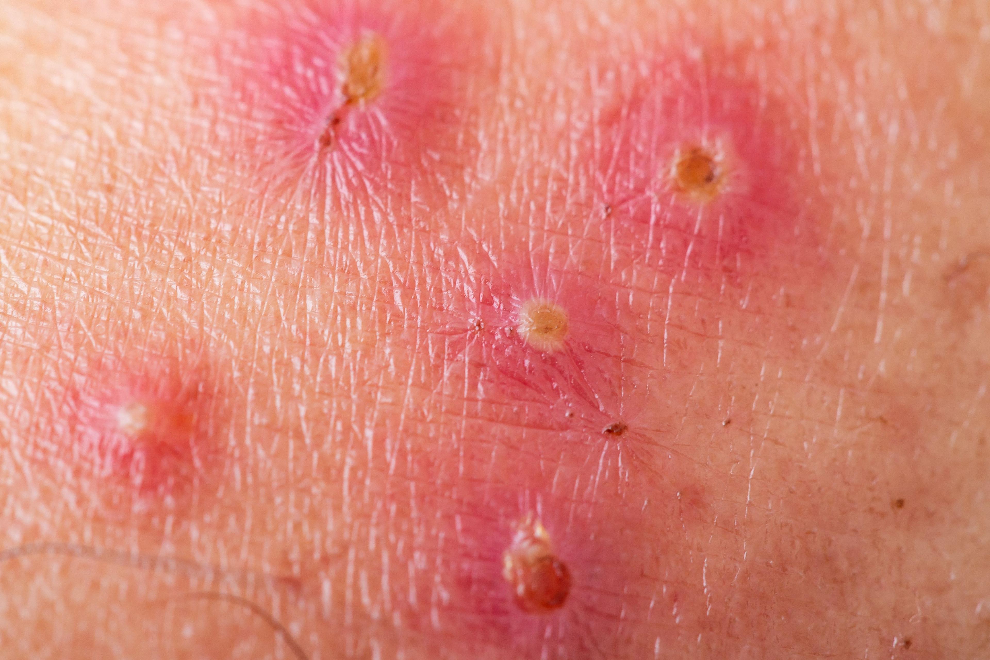 Study: Expert Panel Compiles Main Pediatric Impetigo Controversies