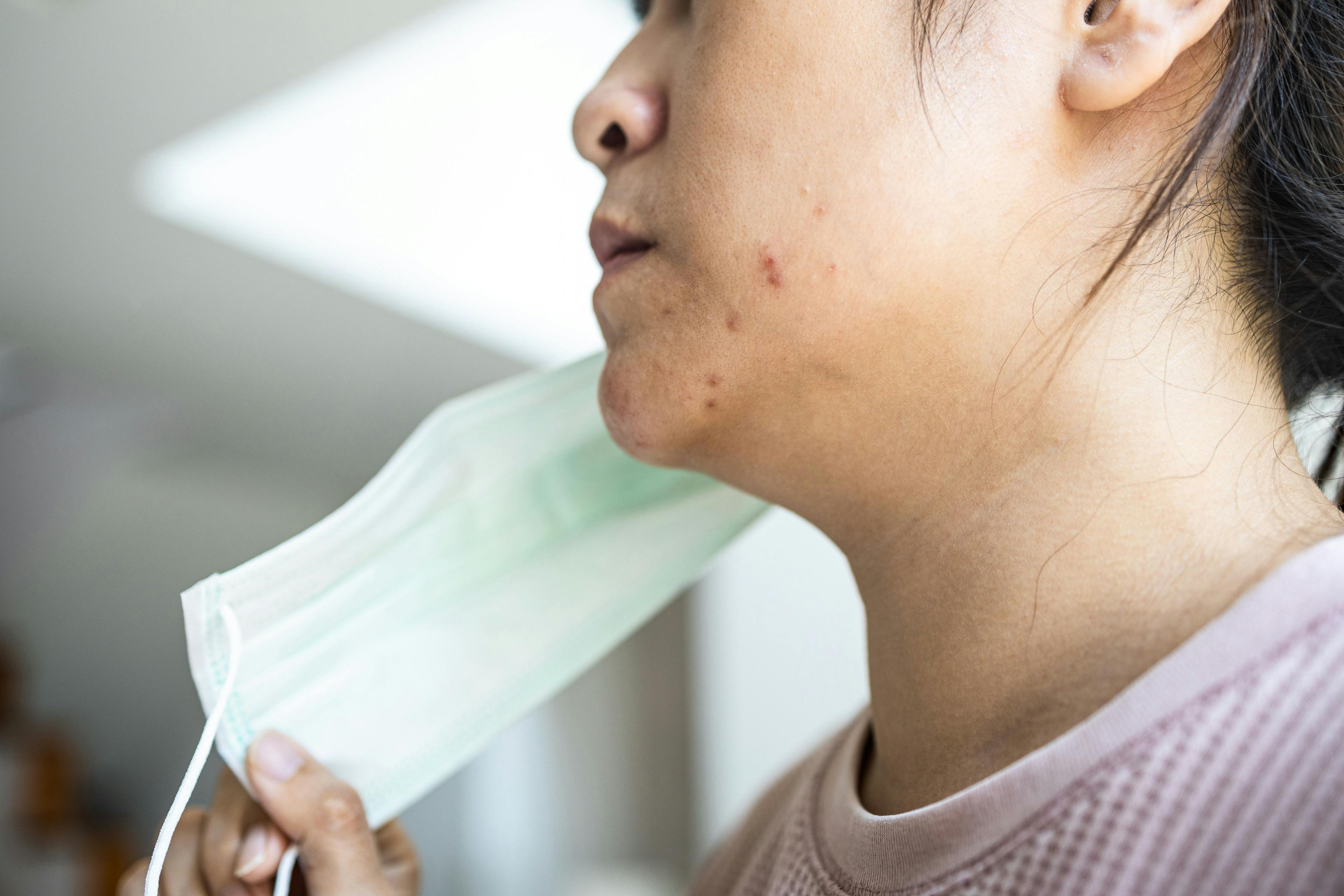 Asian woman with acne and face mask | Image Credit: © Satjawat -stock.adobe.com