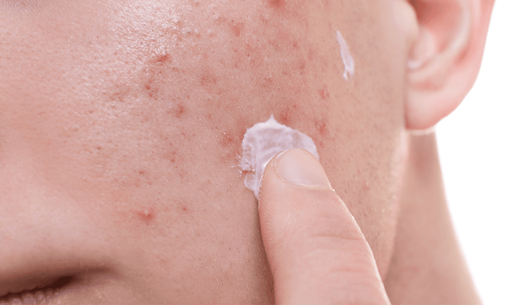 New Sol-Gel cream shows positive phase 3 results for acne vulgaris