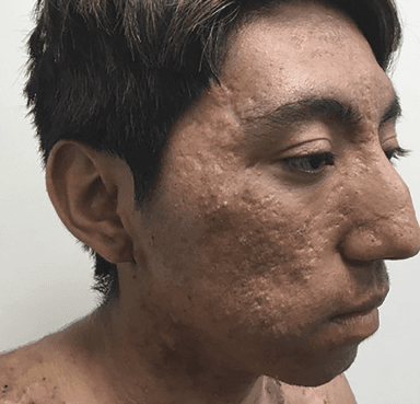 A 17-year-old acne patient at baseline