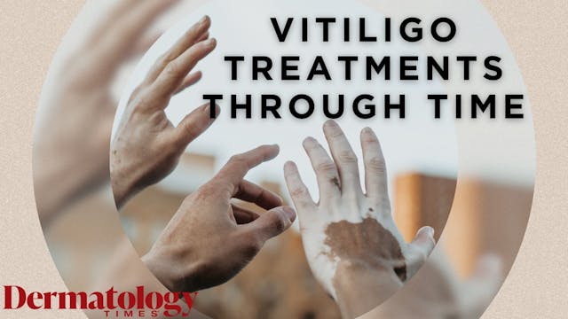 SLIDESHOW: Vitiligo Treatments Through Time