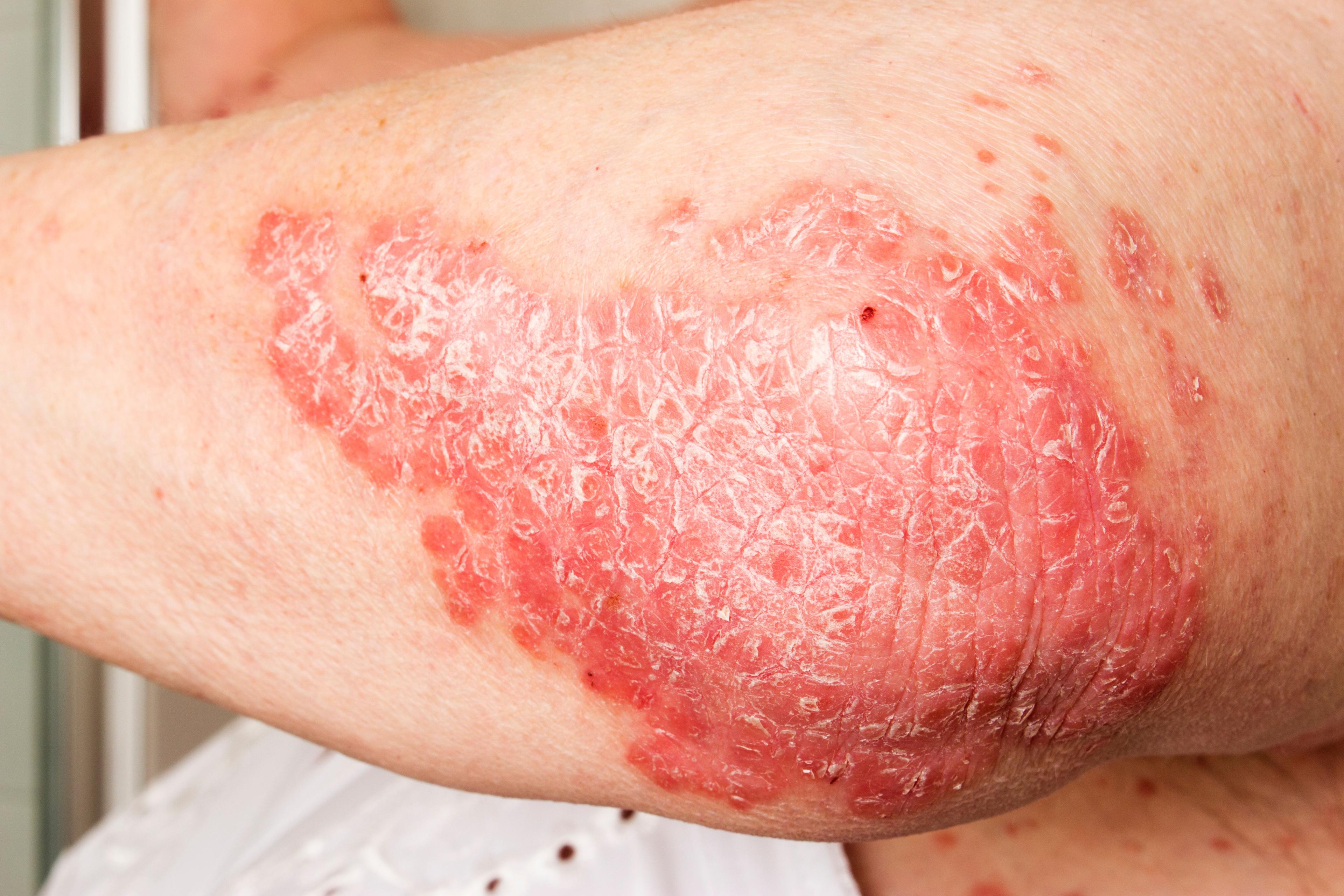 Psoriasis on the elbow