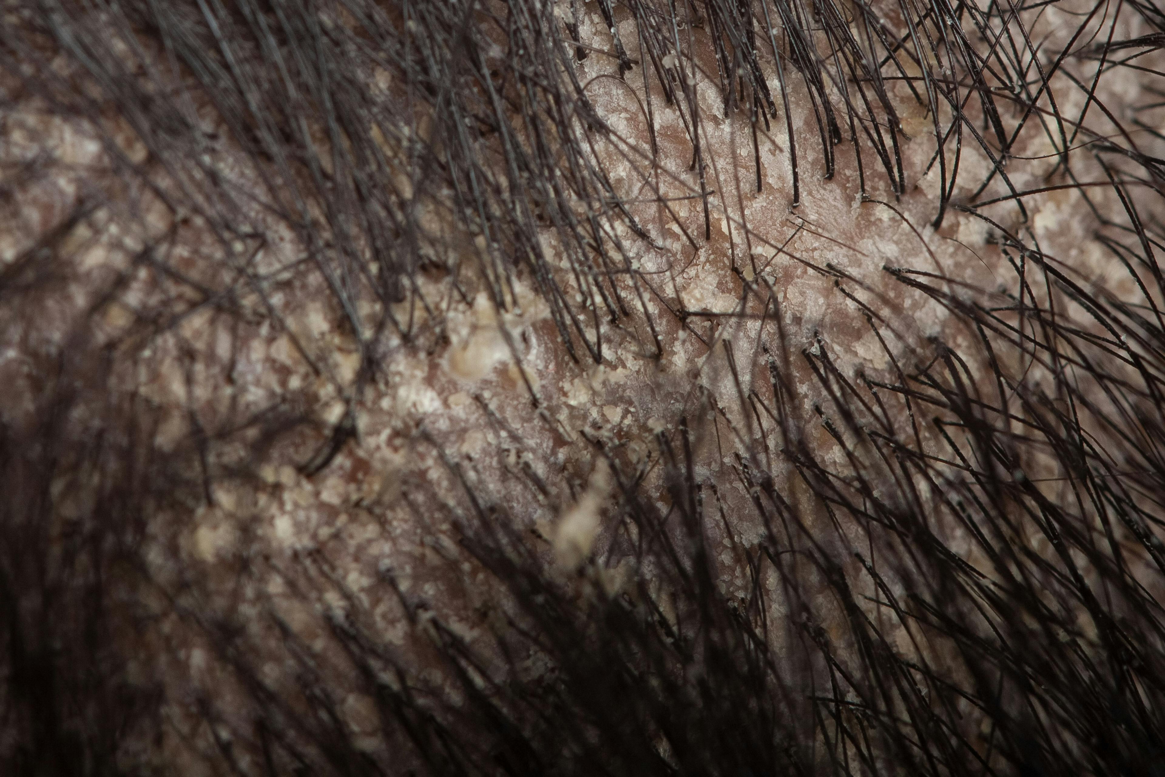macro view of hair root or scalp with dandruff, seborrheic dermatitis | Image Credit: © Dharma - stock.adobe.com