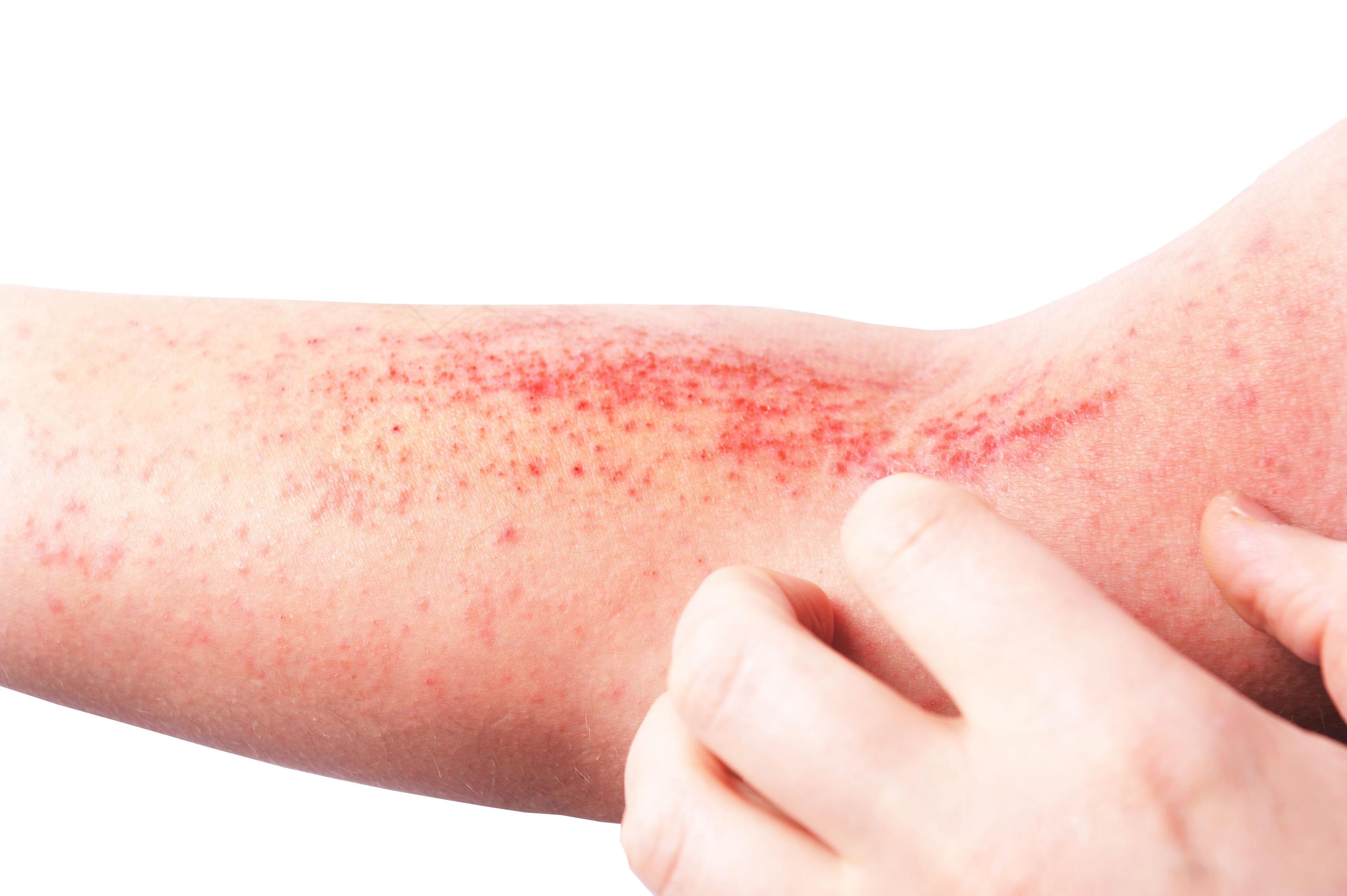 Clinical Presentations of Pediatric AD and Shin Guard Dermatitis 