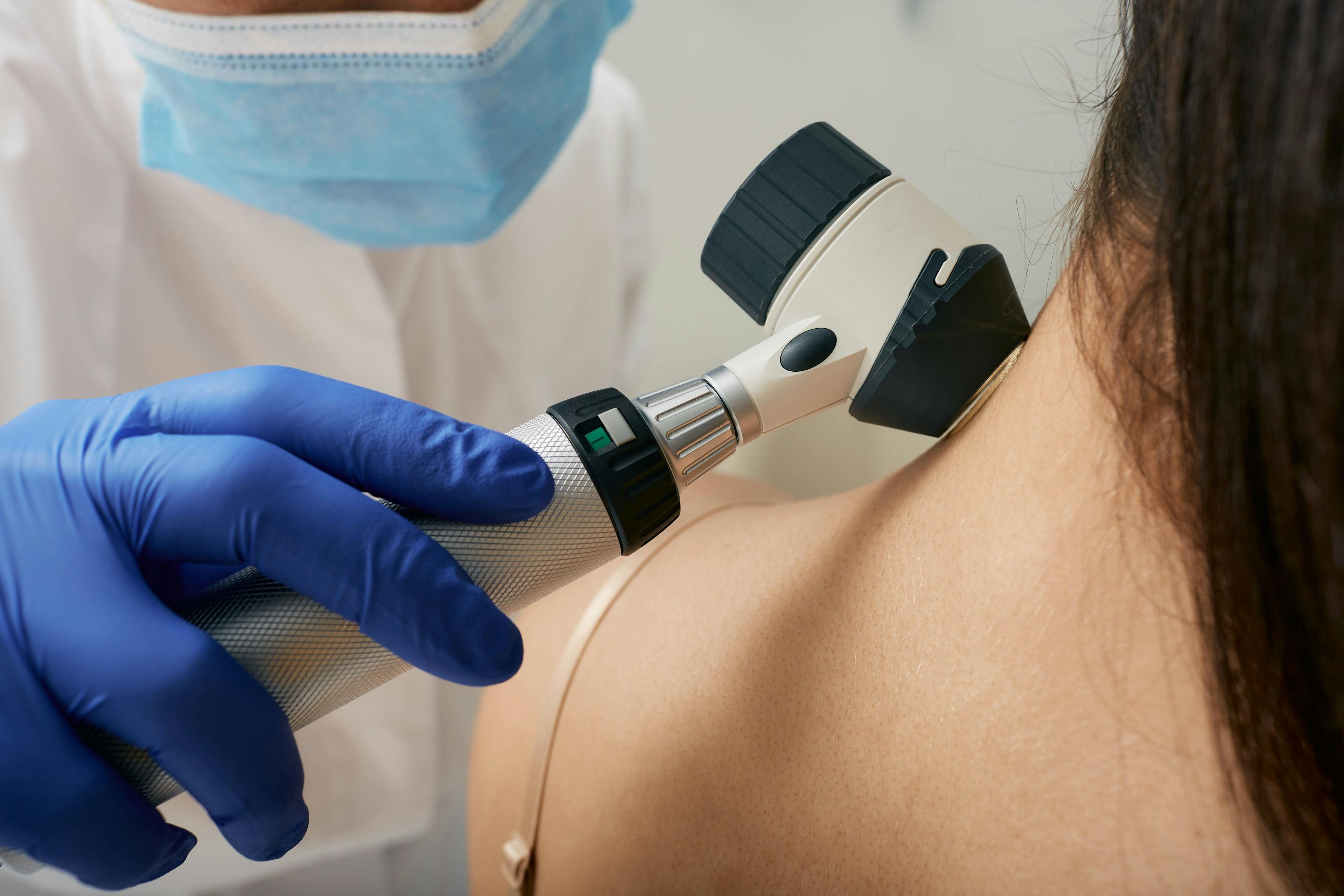 Doctor examines patient's mole with a dermatoscope