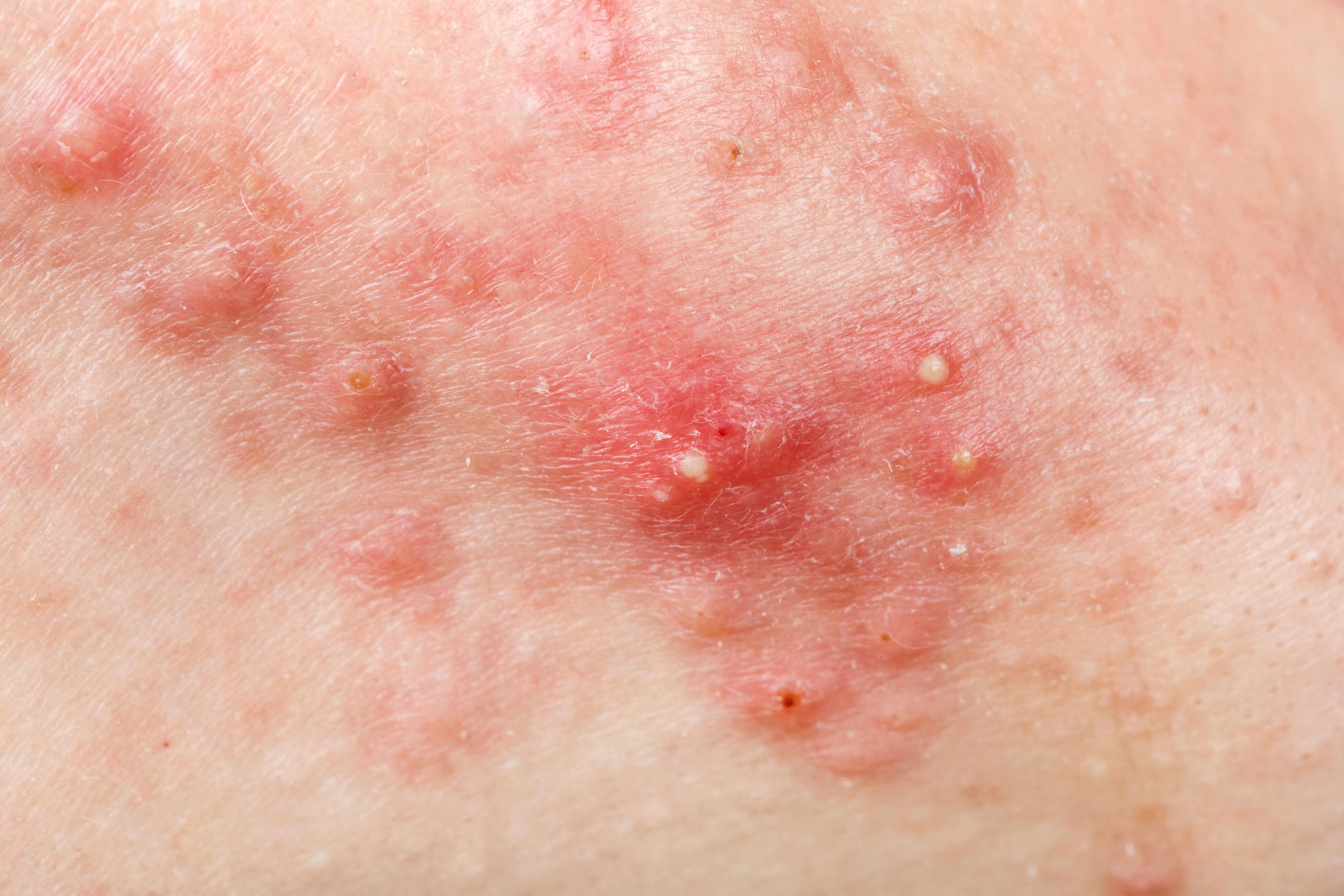 Close up view of acne vulgaris on the face