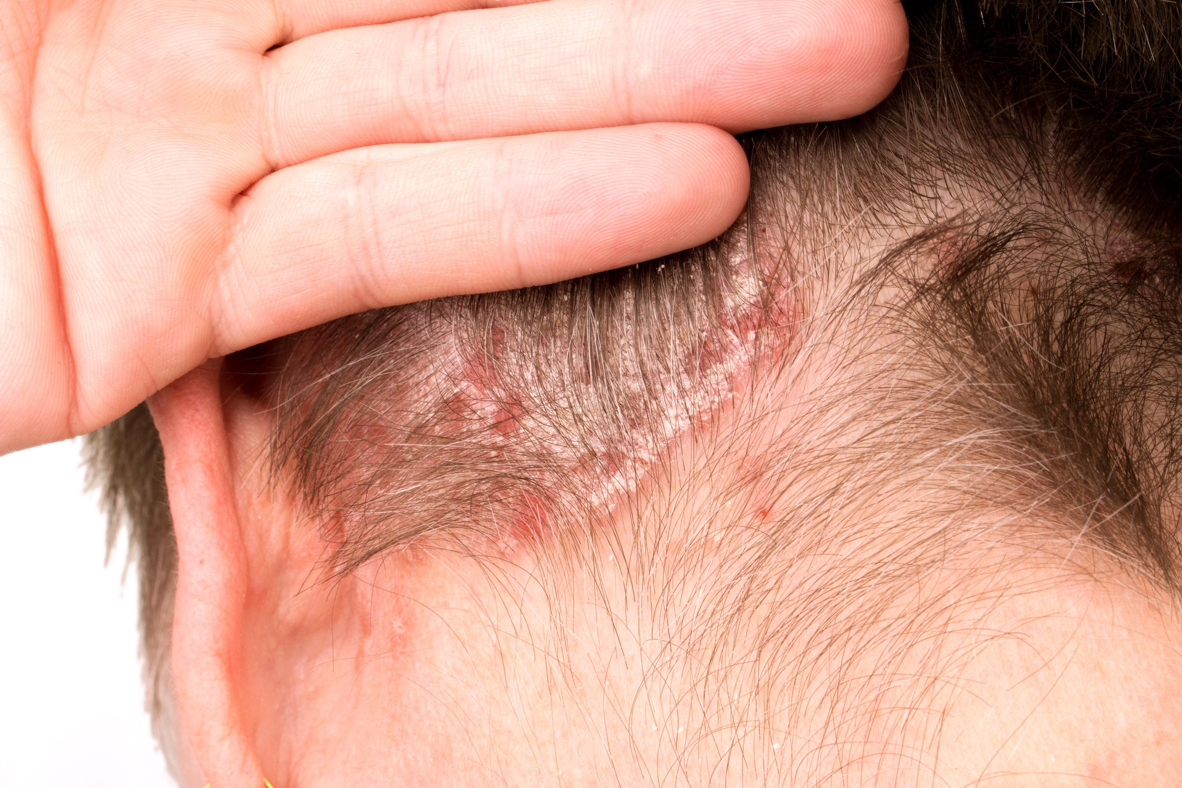 Patient with psoriasis on scalp | Image Credit: © Milan Lipowski - stock.adobe.com