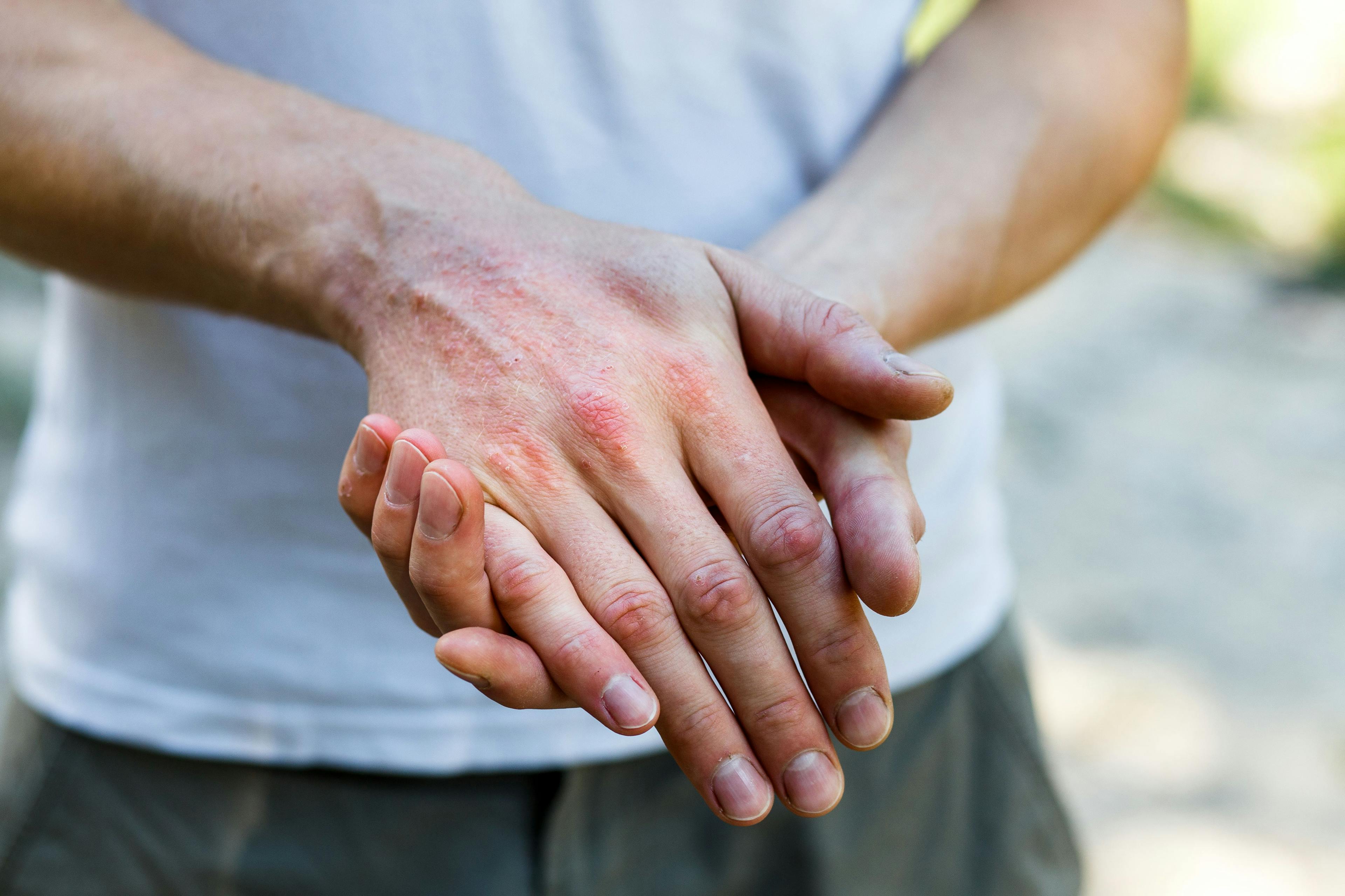 Patient with atopic dermatitis on hands | Image Credit: © Ольга Тернавская - stock.adobe.com