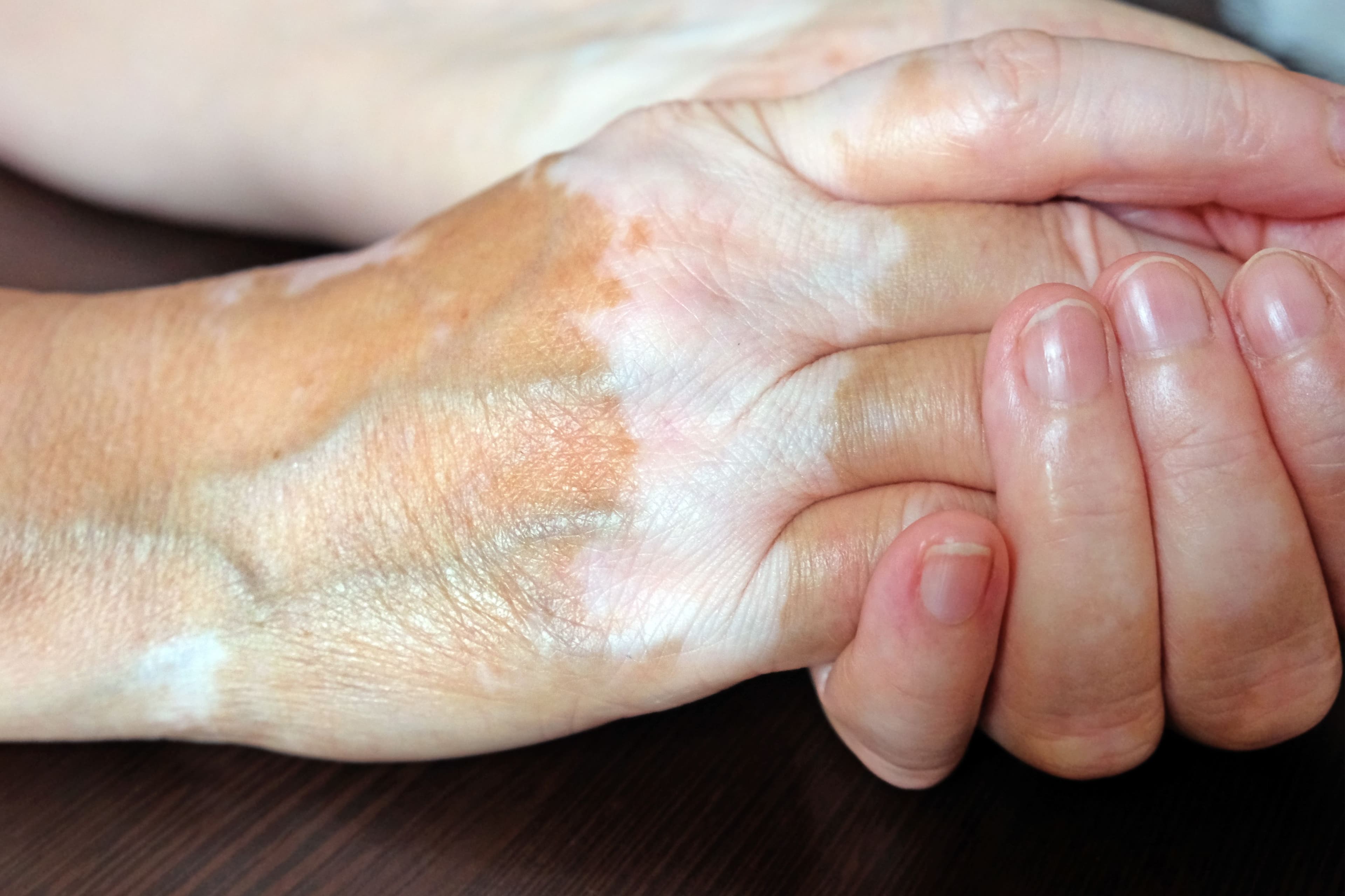 Patient with vitiligo | Image Credit: © Tetiana - stock.adobe.com