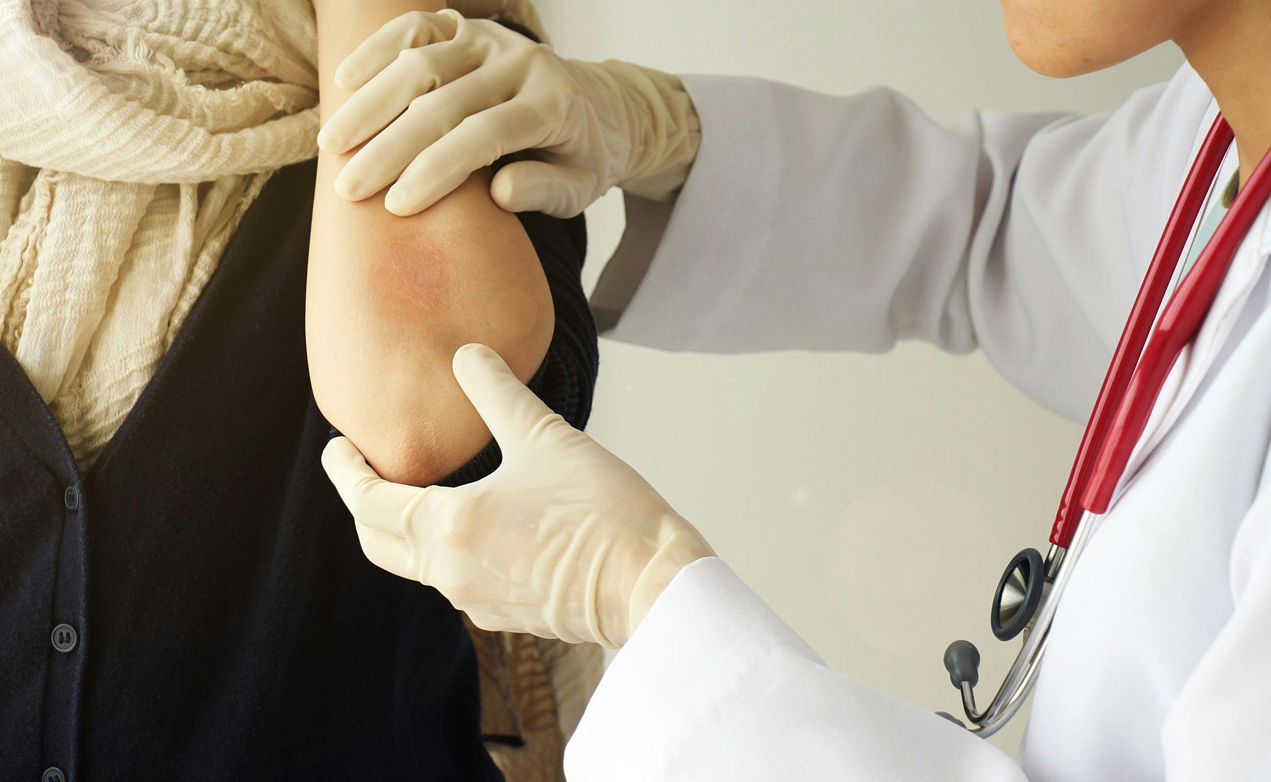 Physician assisting patient with psoriasis | Image Credit: © ARTFULLY-79 - stock.adobe.com