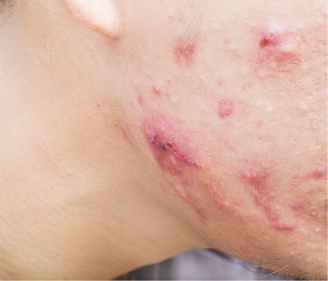 Acne vulgaris