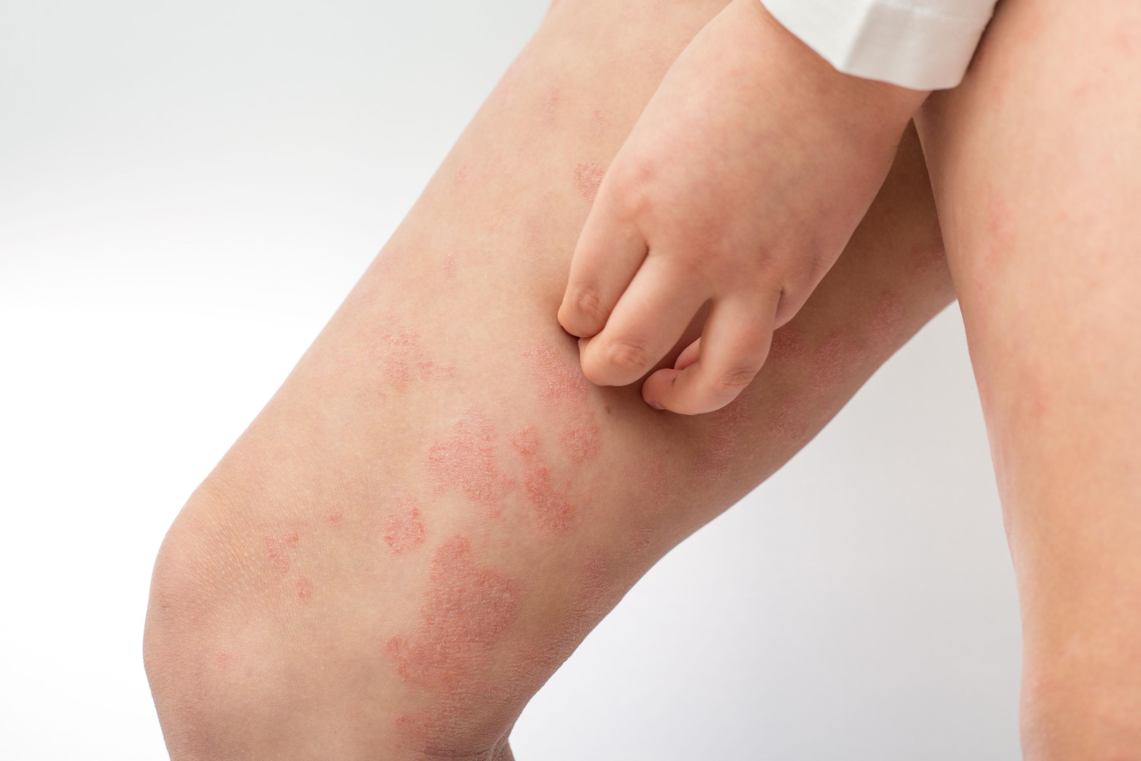 Child scratches leg with plaque psoriasis