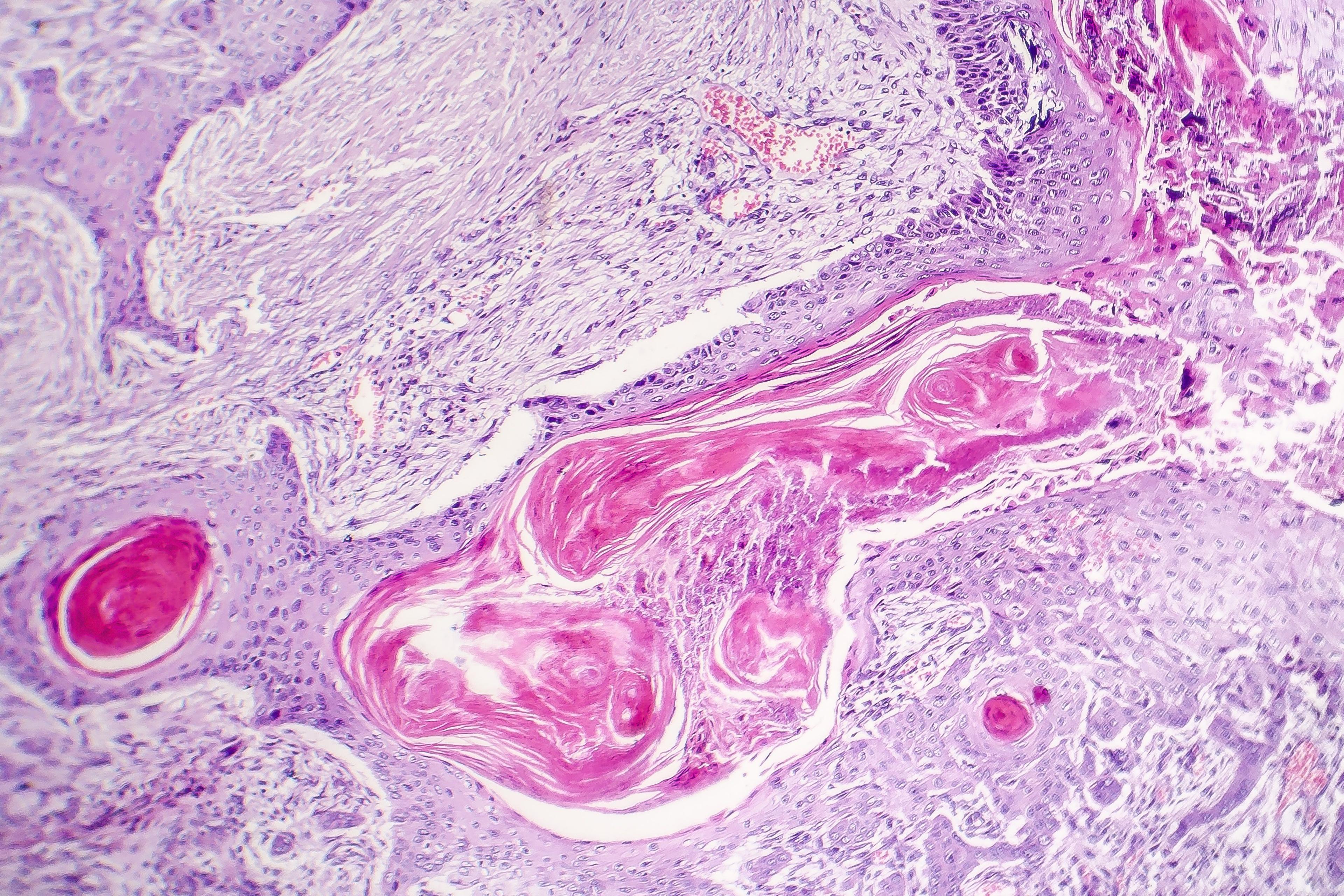 squamous cell carcinoma