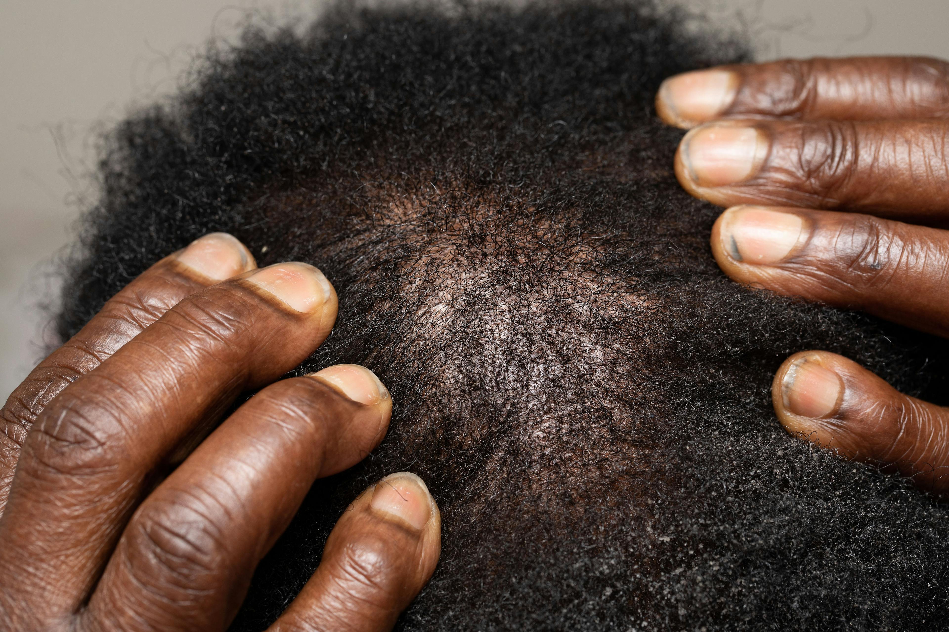Patient with hair loss on scalp | Image Credit: © Alessandro Grandini - stock.adobe.com