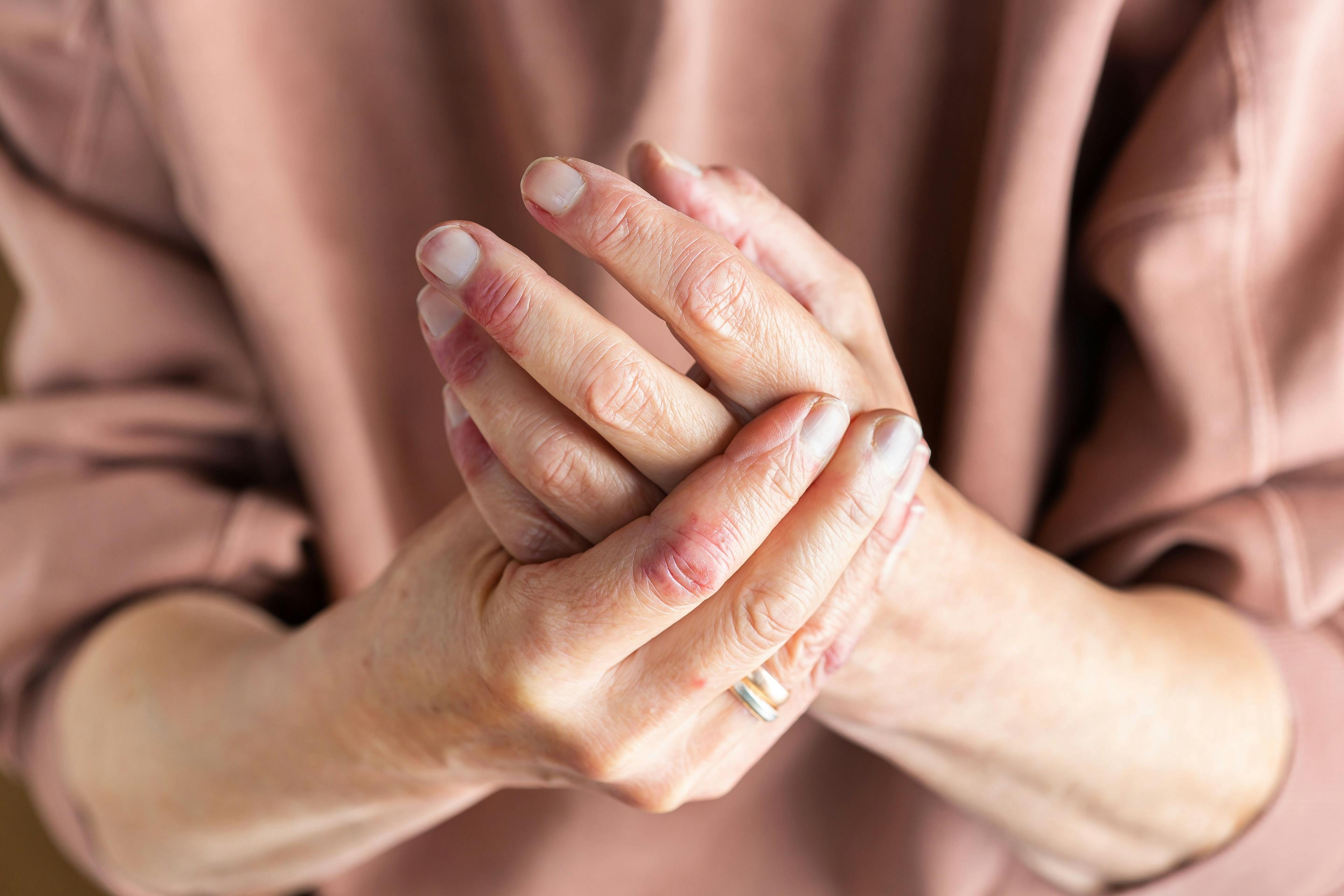 Patient hands with atopic dermatitis | Image Credit: © aamulya - stock.adobe.com