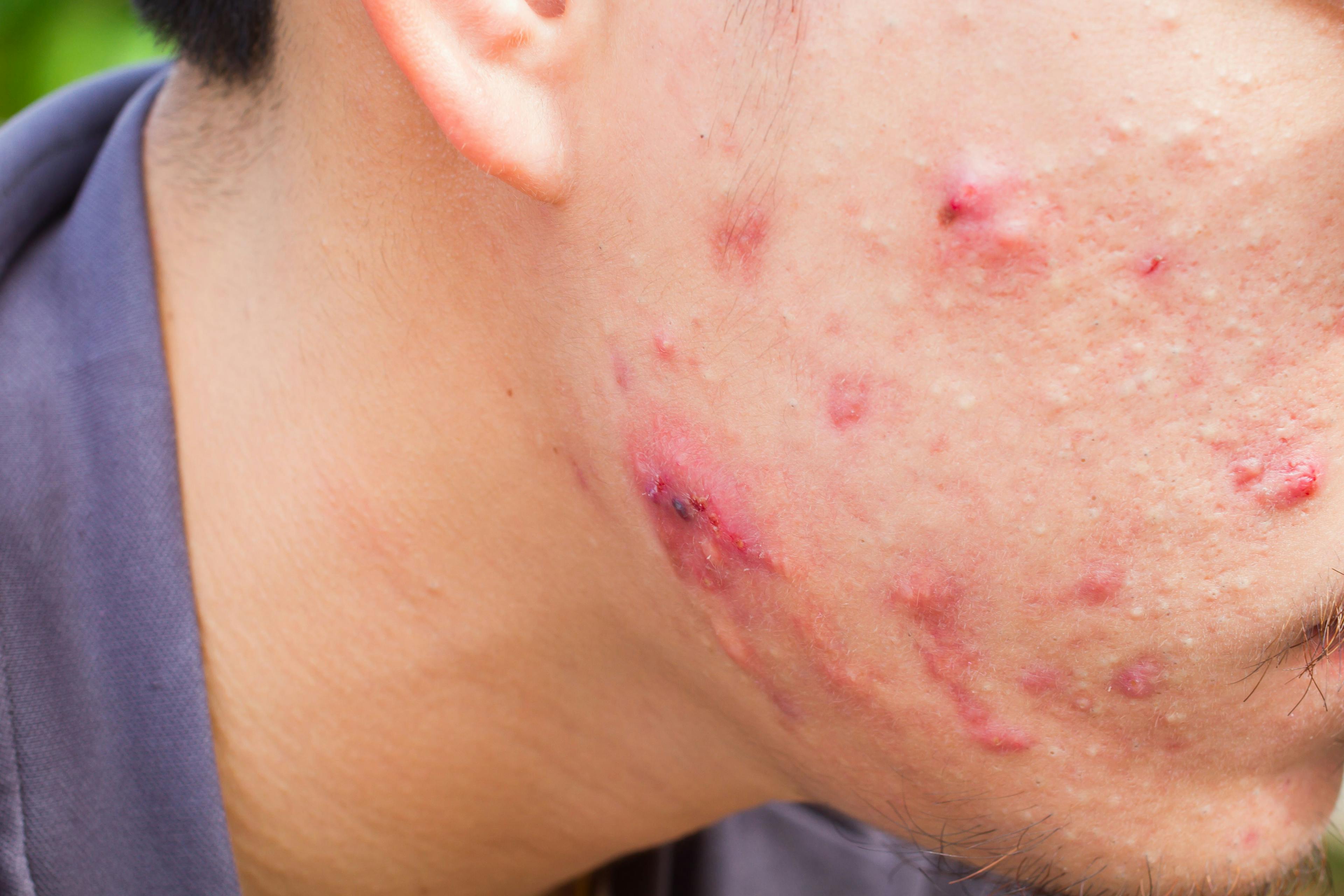 Cystic acne | Image credit: © a3701027 - stock.adobe.com