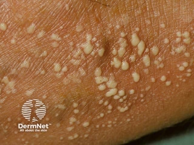 Patient with generalized pustular psoriasis | Image Credit: © DermNet