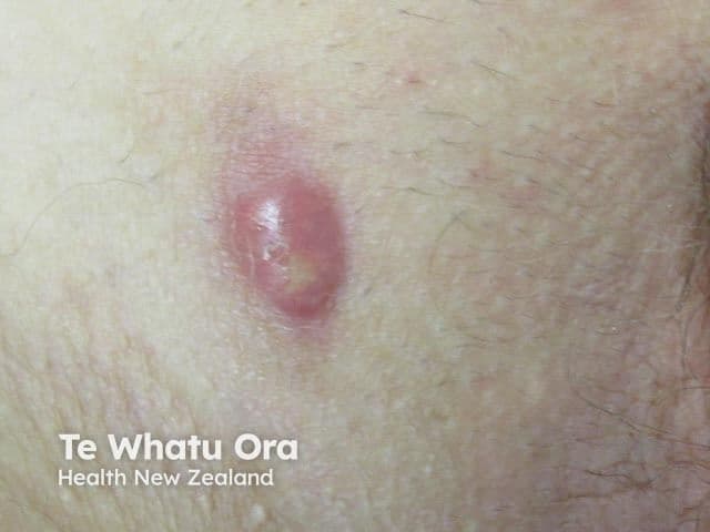 Patient with HS | Image Credit: © dermnetnz.org