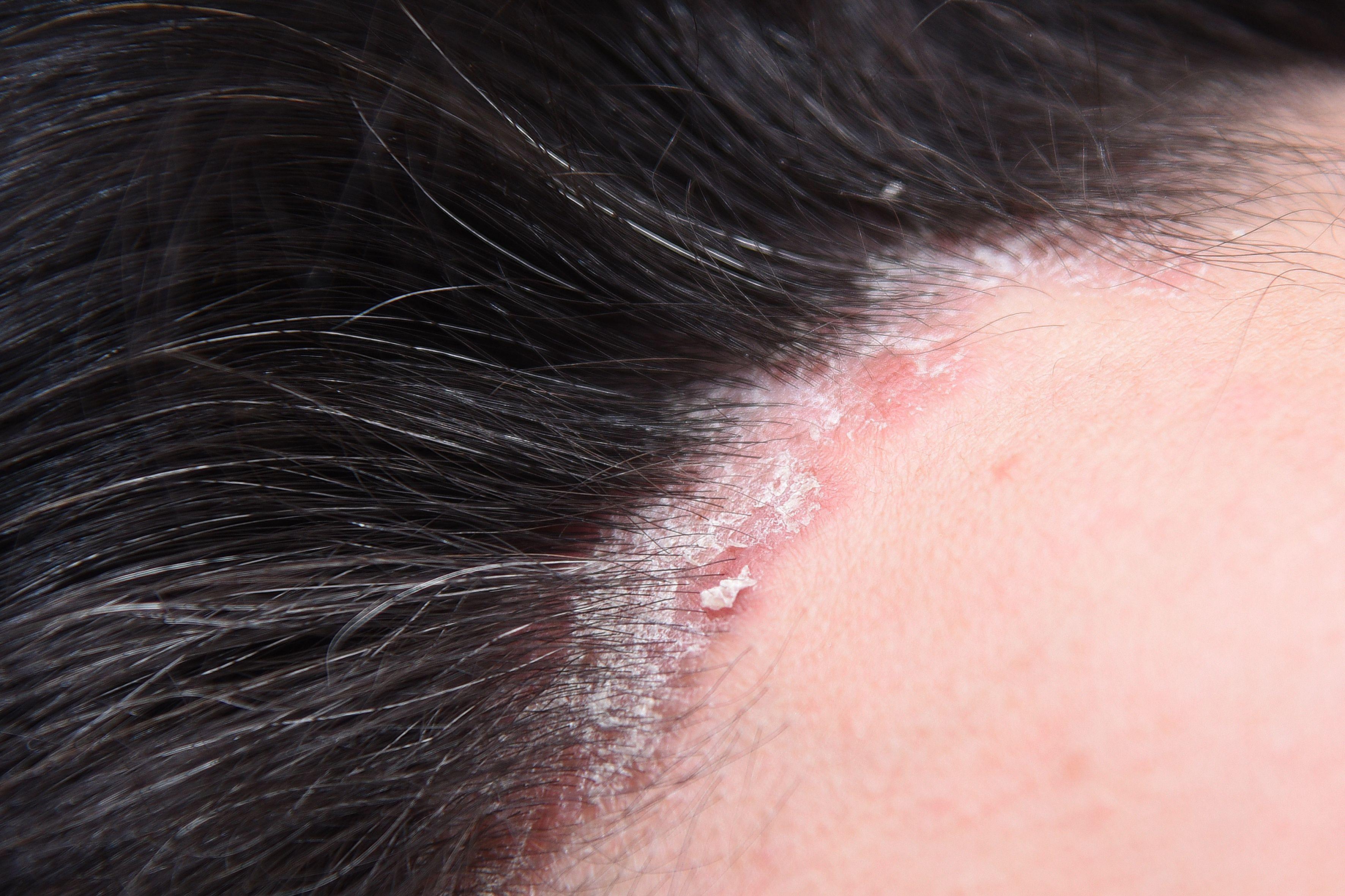 Patient with scalp psoriasis | Image Credit: © ksu_ok - stock.adobe.com