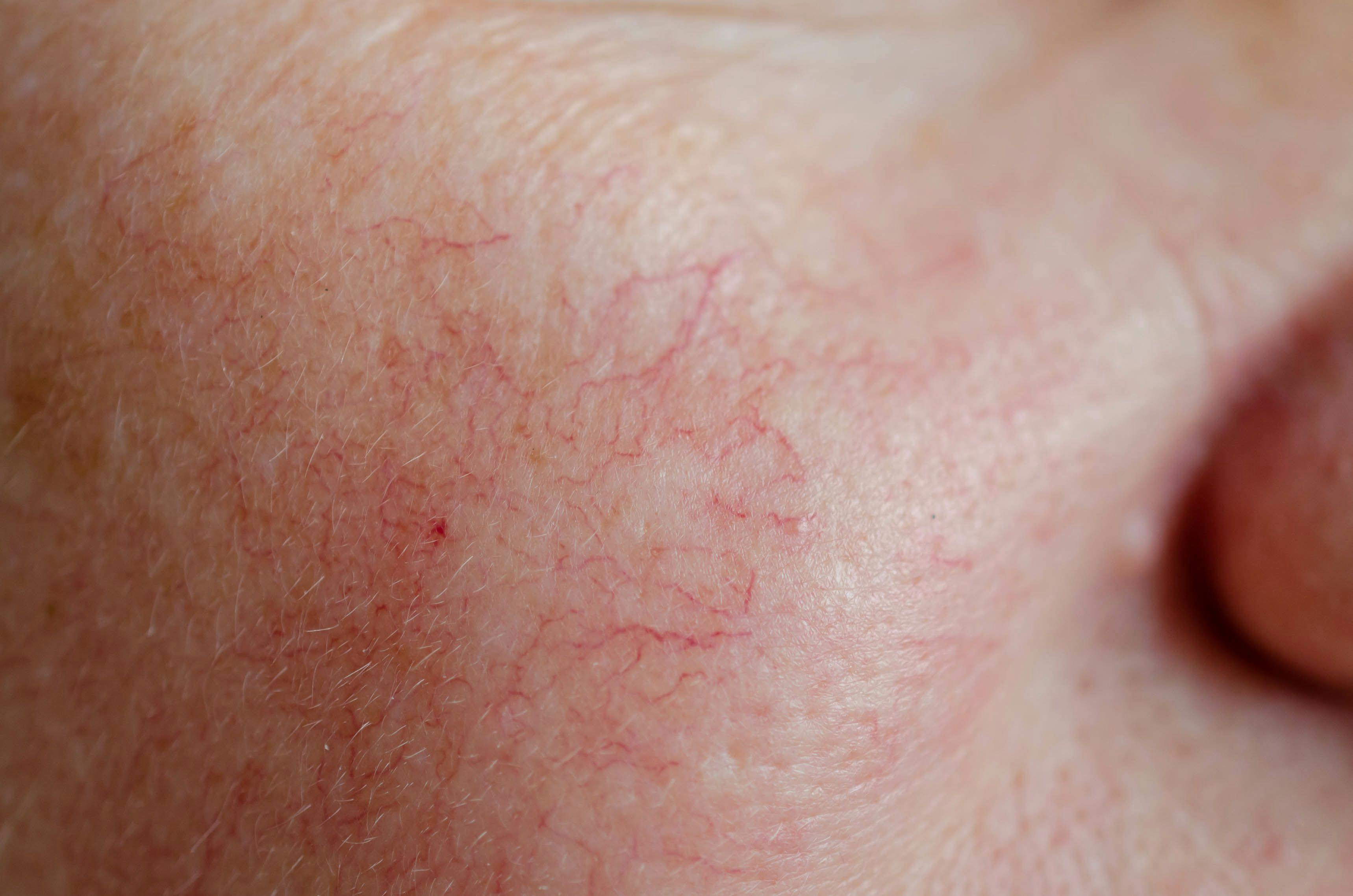 Patient with rosacea on cheeks | Image Credit: © Svetlana - stock.adobe.com