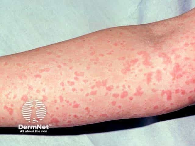 Chronic inducible urticaria on arm | Image Credit: © dermnetnz.org