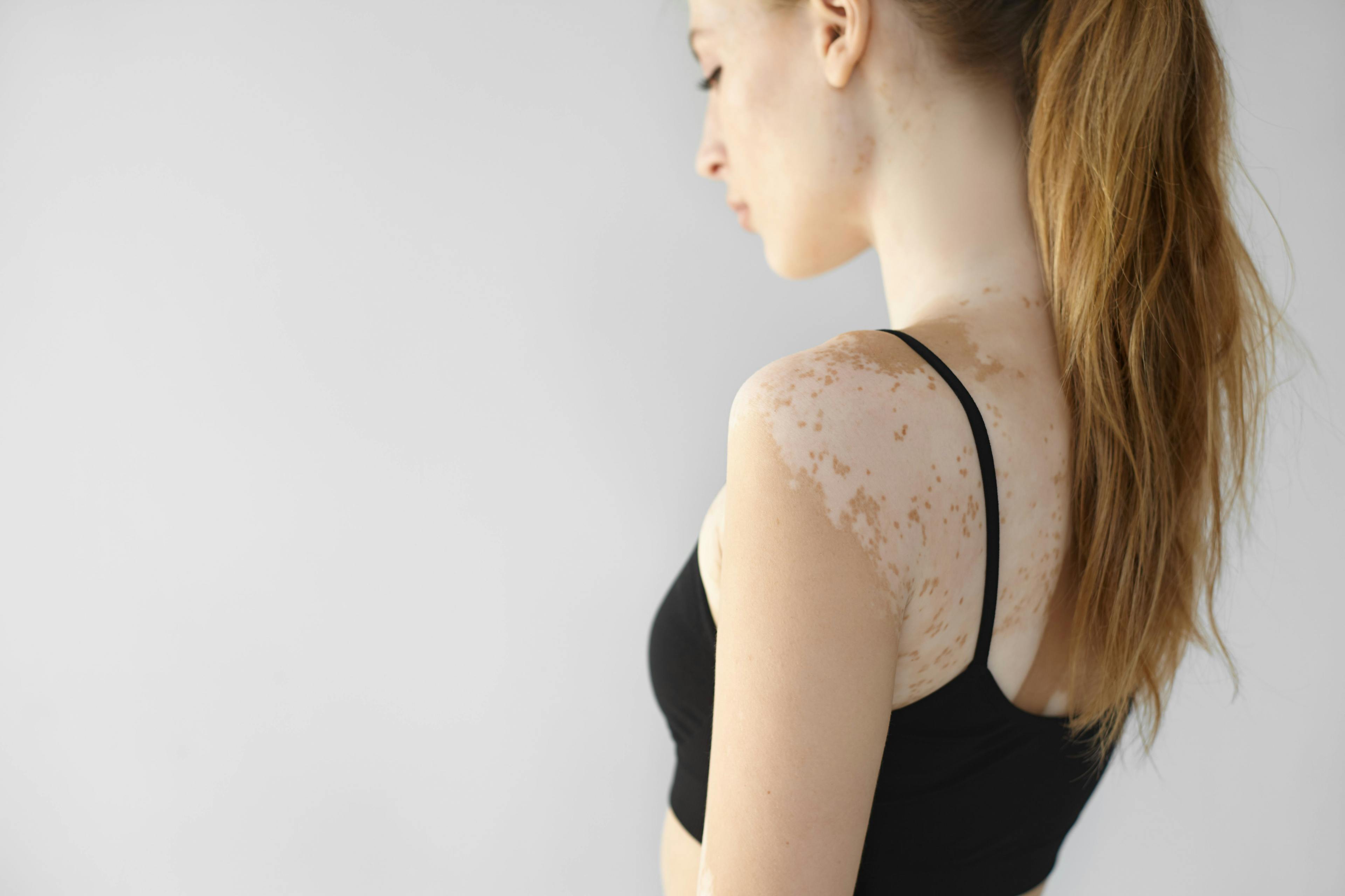 Patient with vitiligo | Image Credit: © shurkin_son - stock.adobe.com