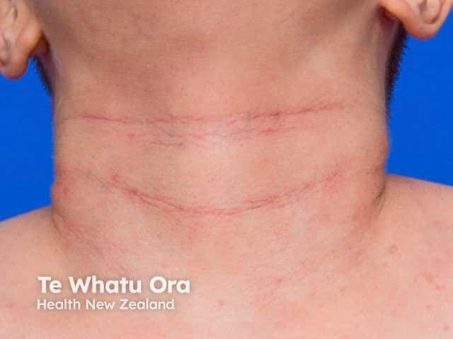 atopic dermatitis on the neck | Image credit: DermNet