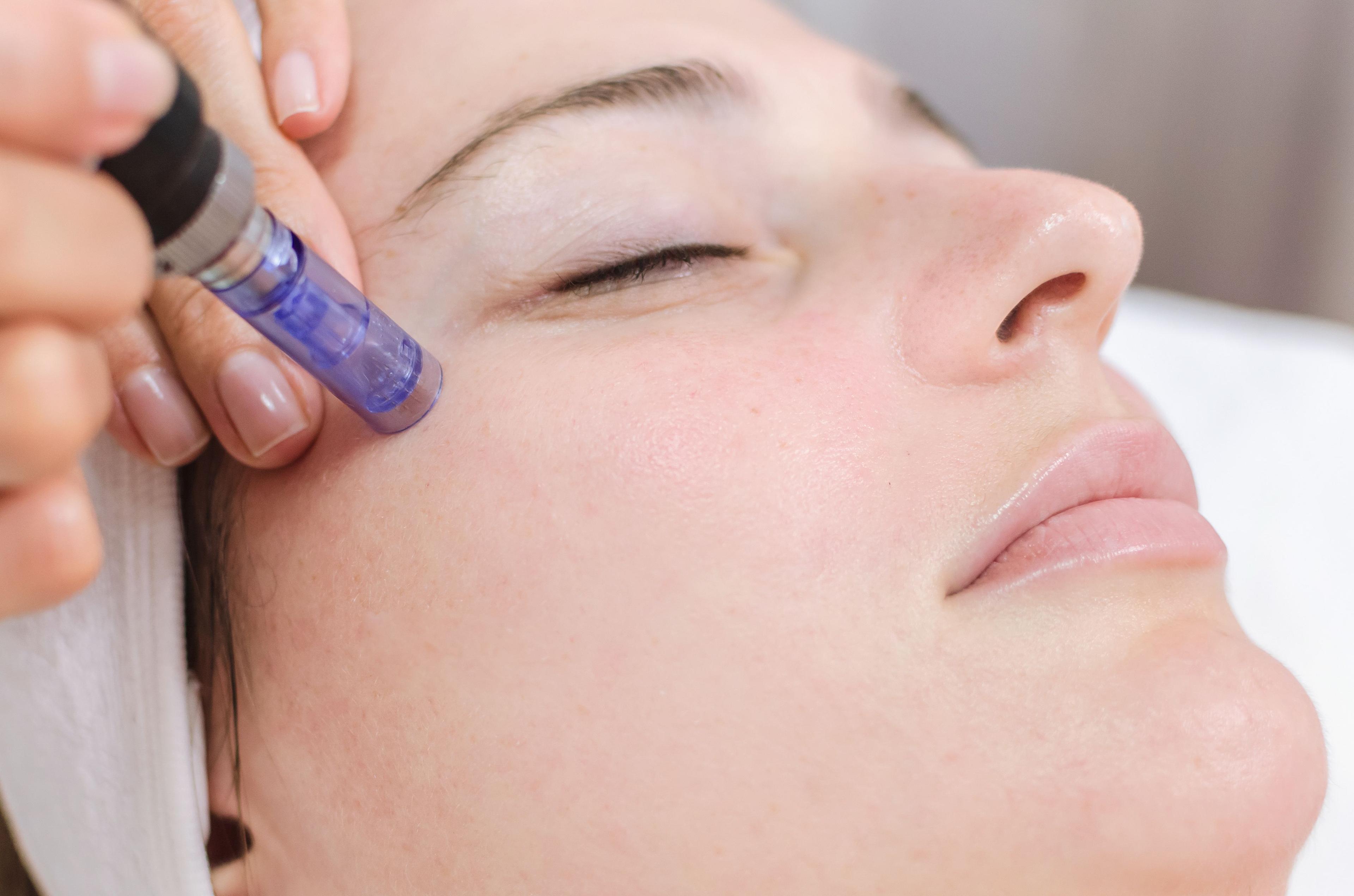 microneedling