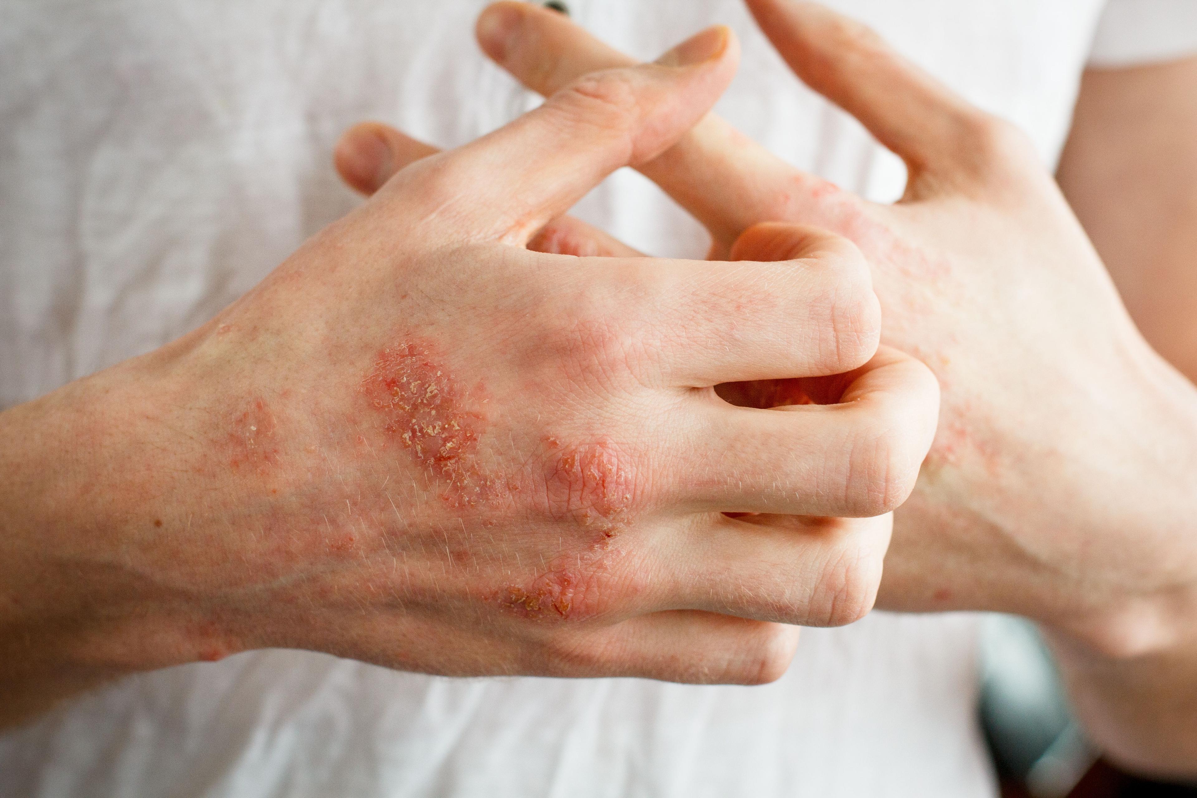 Close up view of person with eczema on the hands