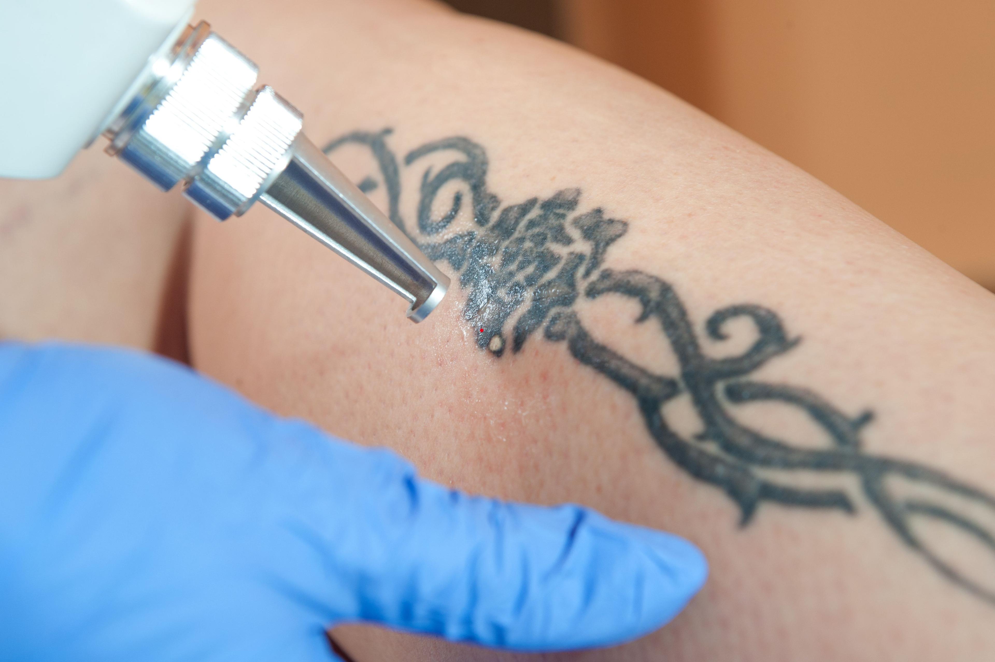 tattoo removal