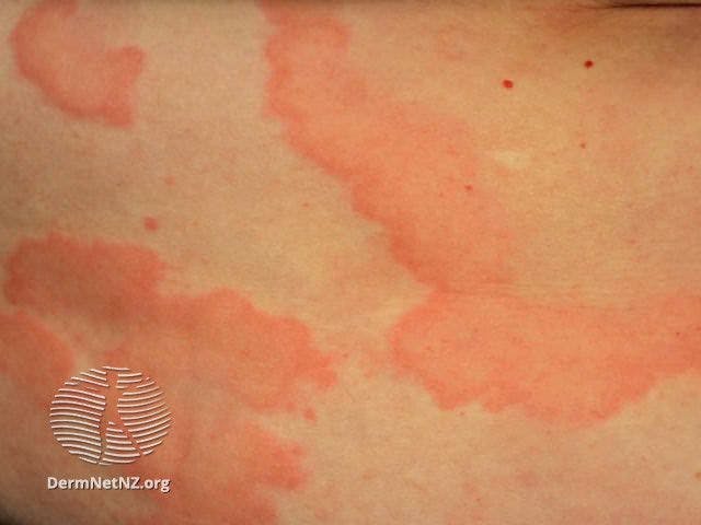 Spontaneous urticaria

Image courtesy of DermNetZ