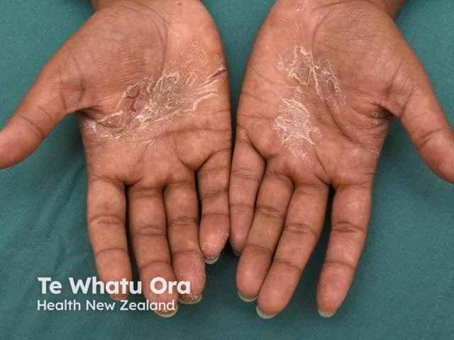 Patient with chronic hand eczema | Image credit: © DermNet