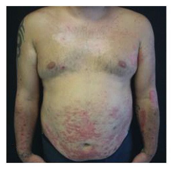 Case Report: Efficacy of Dupilumab for Acquired Reactive Perforating Collagenosis Associated with Atopic Dermatitis