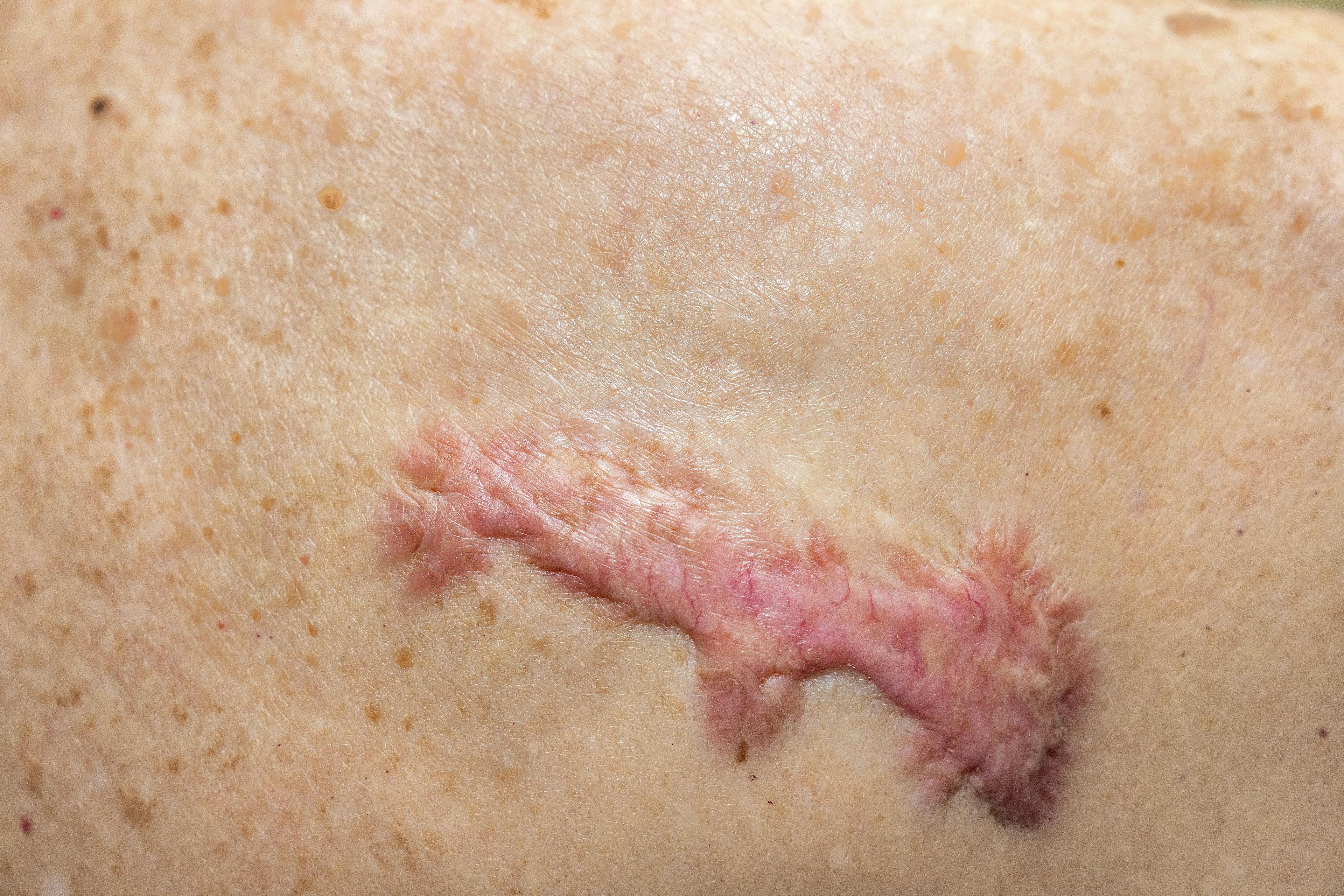 Patient with spontaneous keloid scar