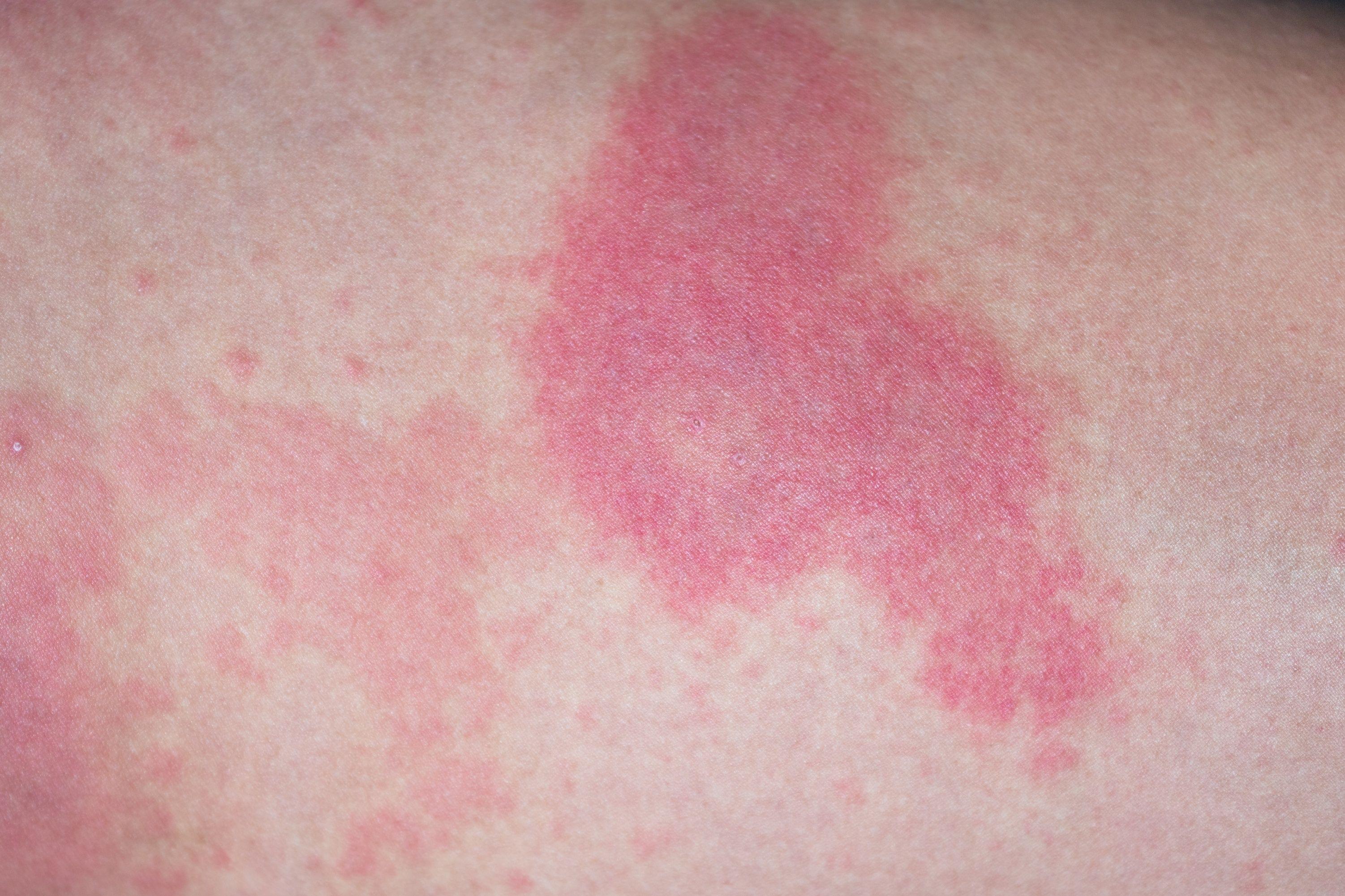 Dupilumab Efficacious in Urticaria Symptom, Quality of Life Improvement