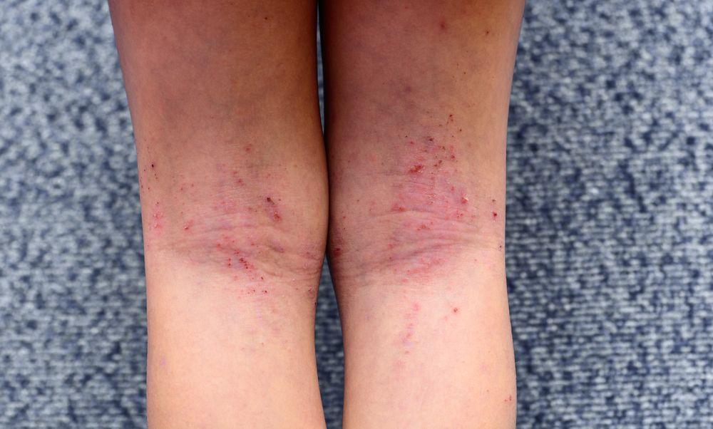 Atopic dermatitis of the legs ©GabdrakipovaDilyaraShutterstock