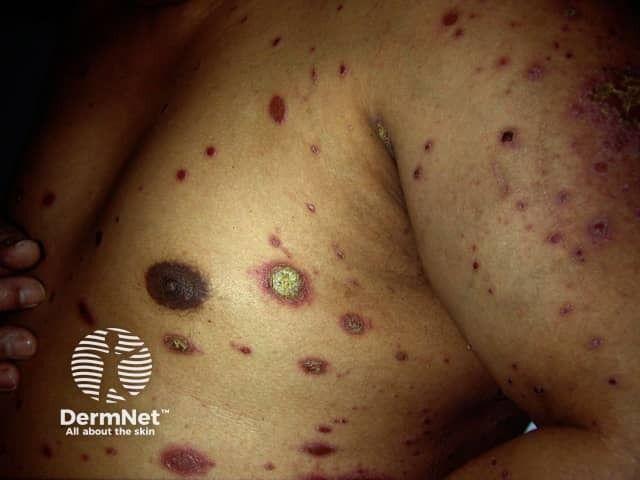 Rash of secondary syphilis on trunk and limbs | Image credit: DermNet